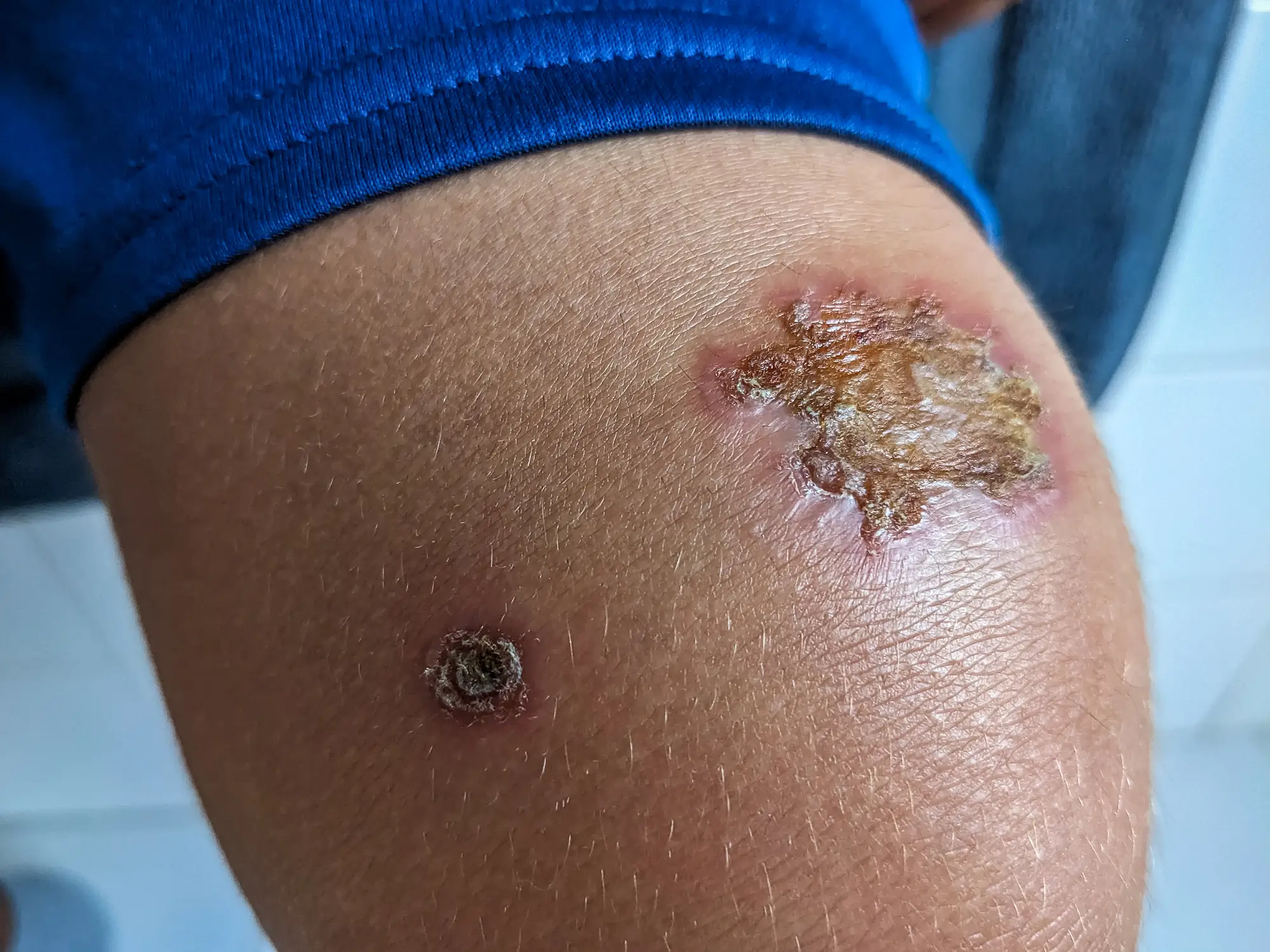 Impetigo sores on a child's knee (Getty Stock Images)
