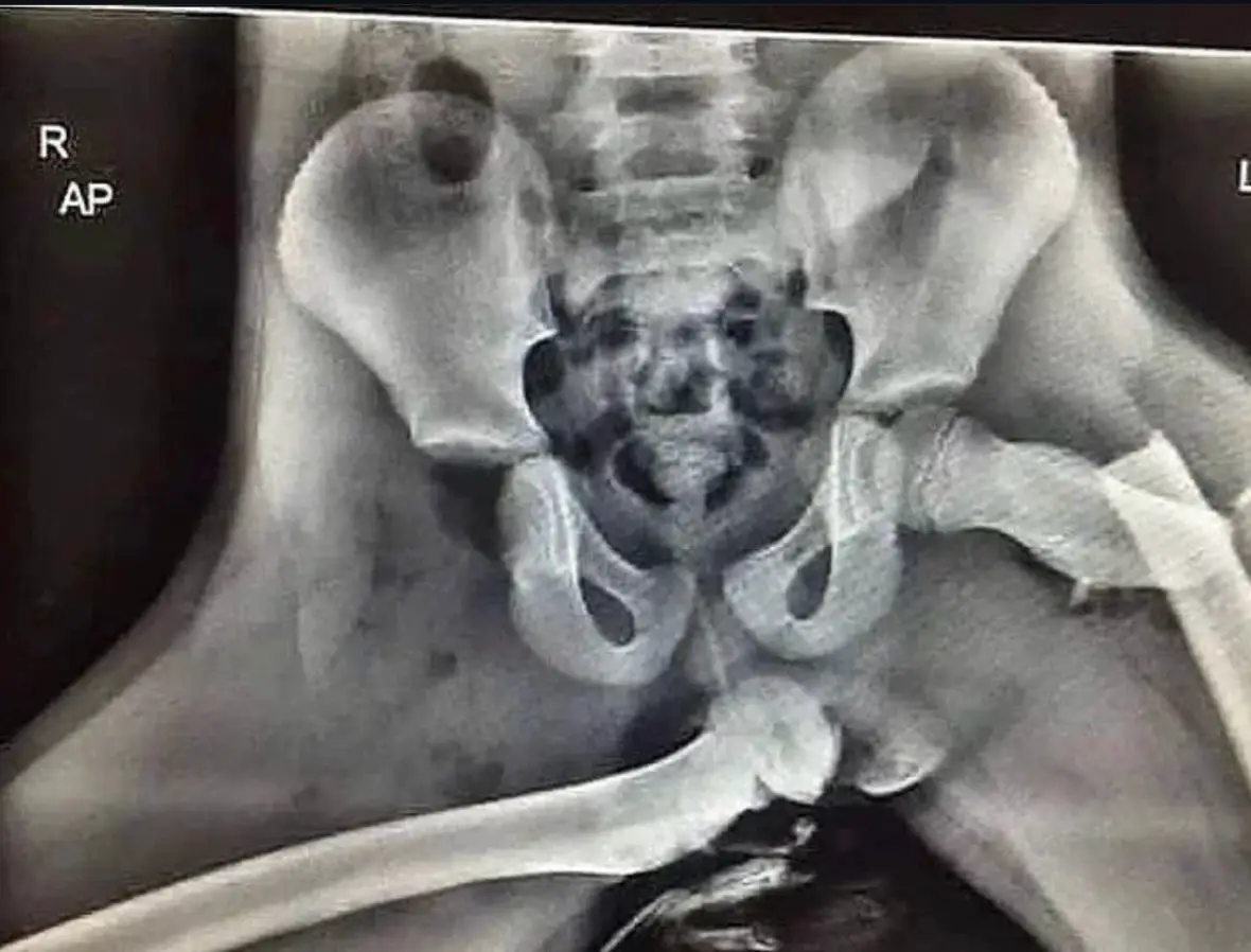 This X-ray shows exactly why you shouldn't put your feet on the dashboard (Dyfed-Powys Police)