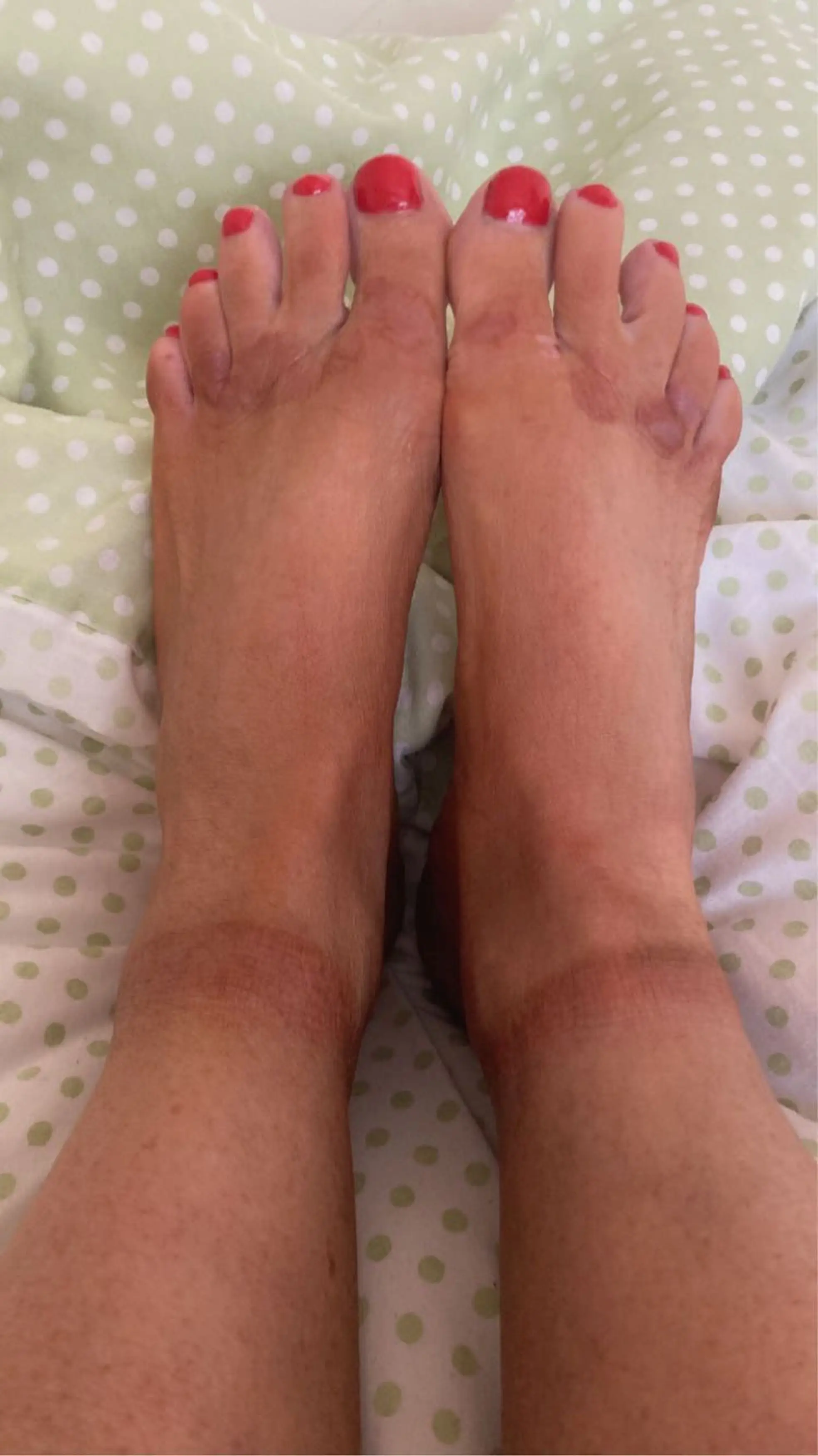 Although healed, Donna has been left with painful welts on her skin (