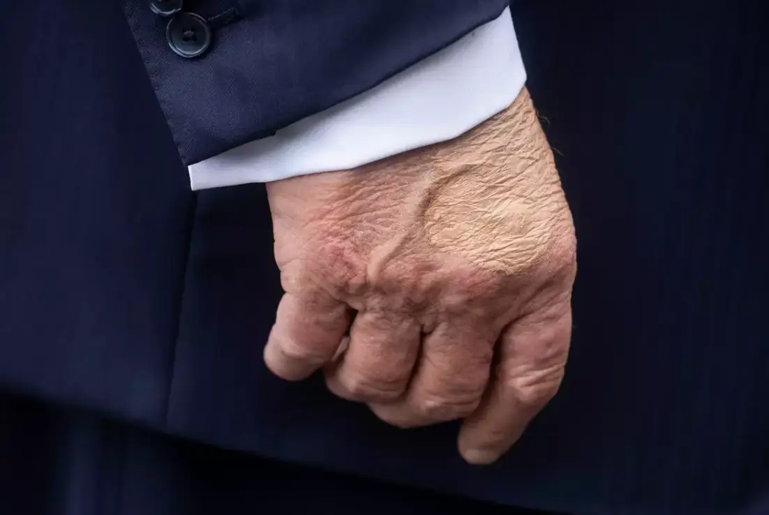Trump's bruised hand also caused a stir online (JIM WATSON / Contributor / Getty Images)