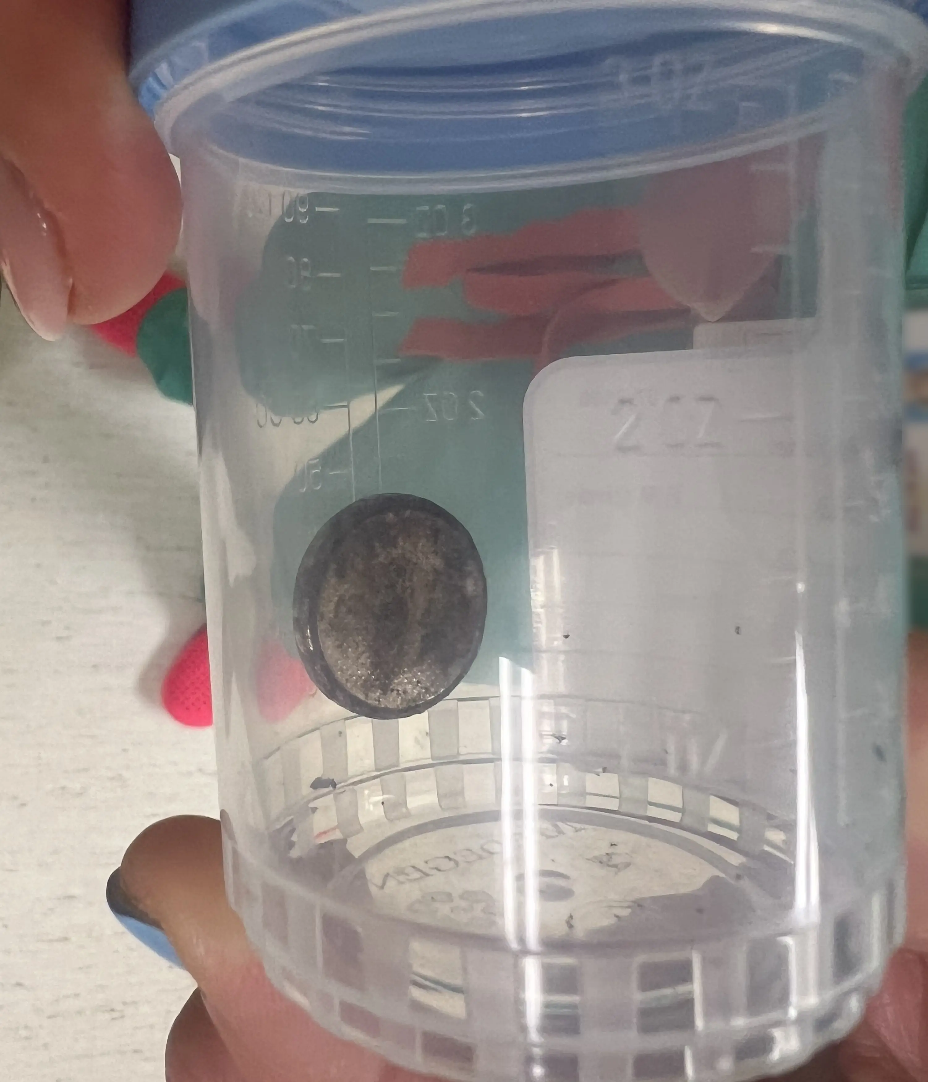 The battery had become lodged in the child's throat. (Kennedy News and Media)