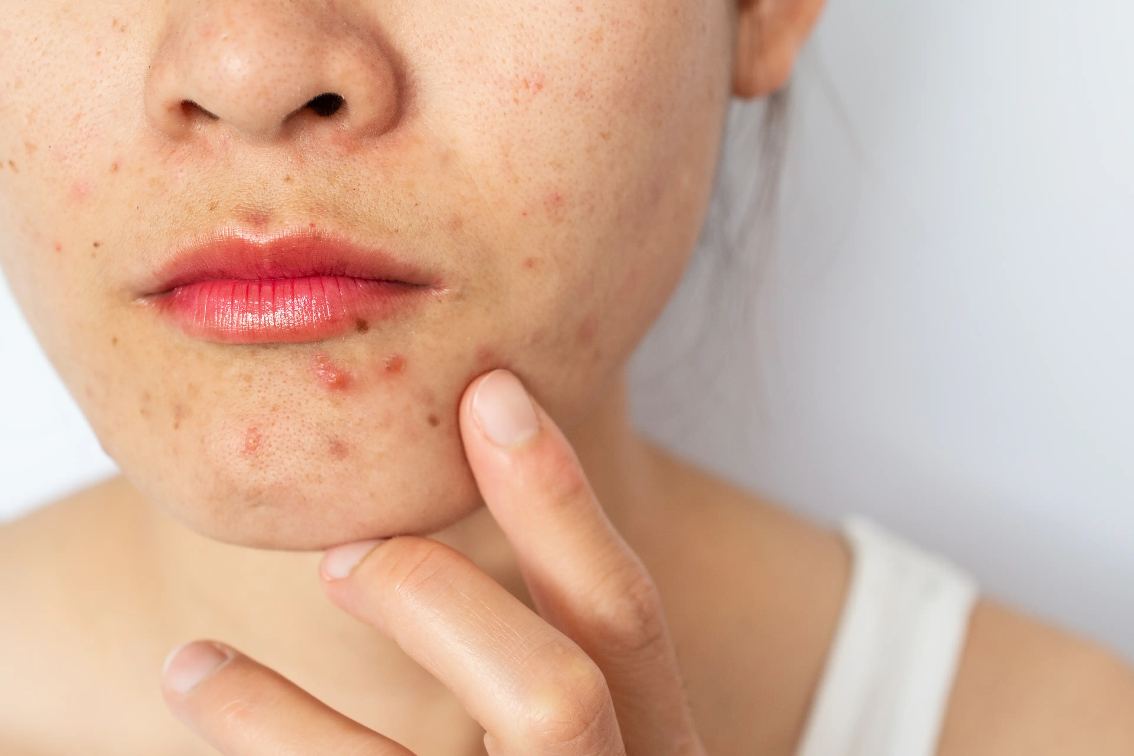Acne can affect your face, as well your chest and back (Getty Stock Image)