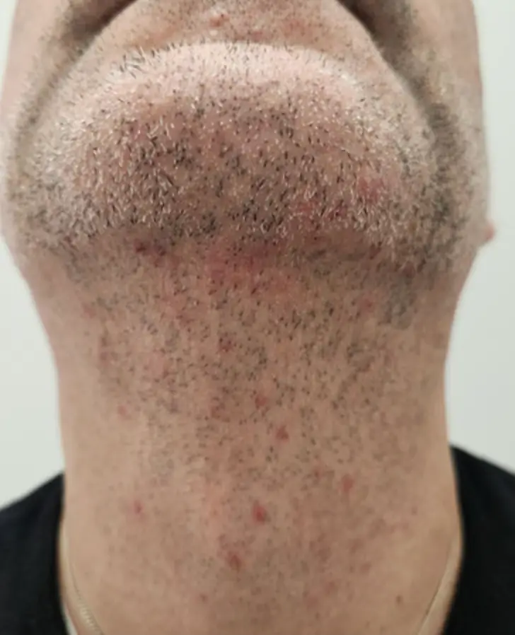 The disease most commonly causes a rash (CDC)