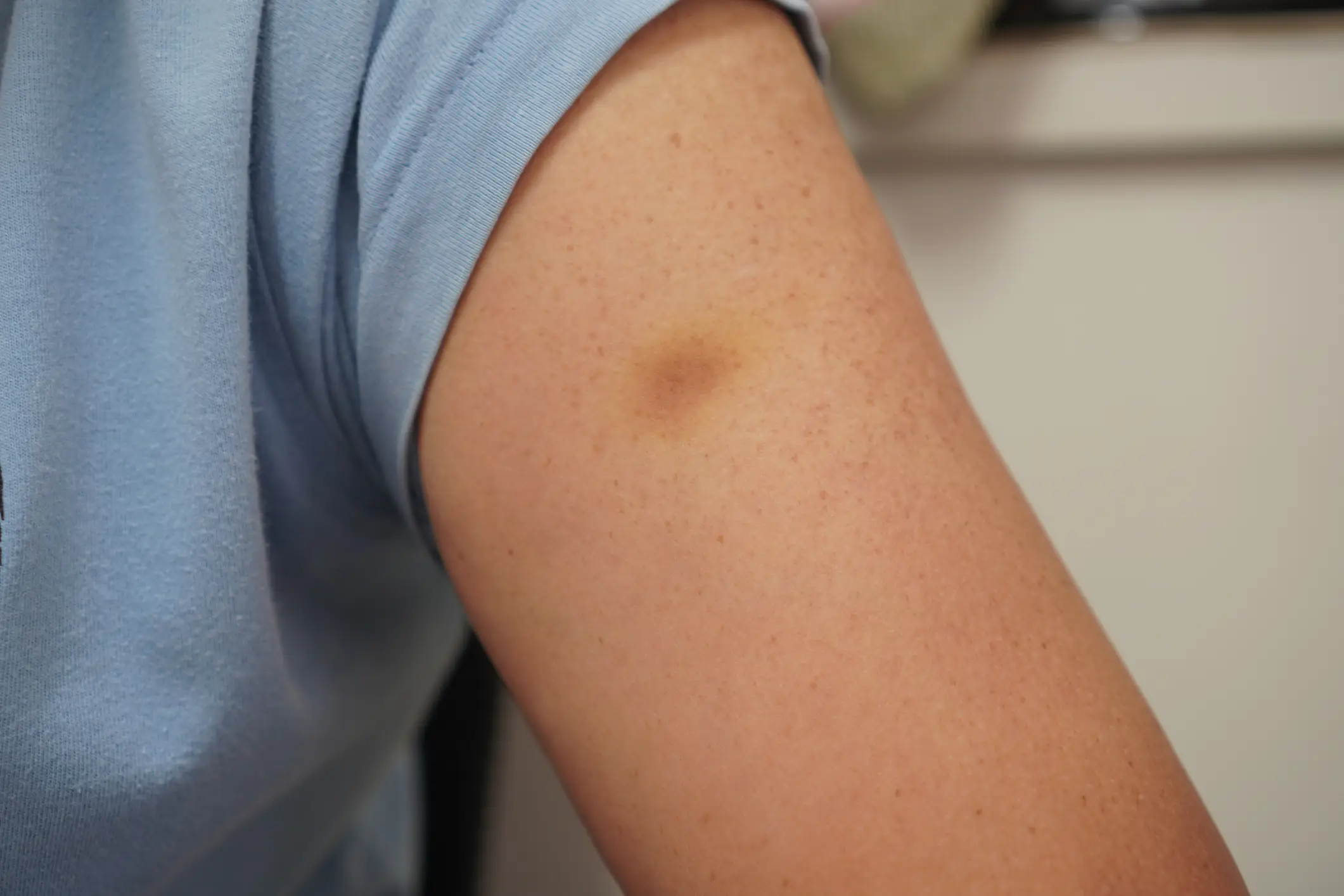 Where do these bruises come from? (Penpak Ngamsathain / Getty Images)