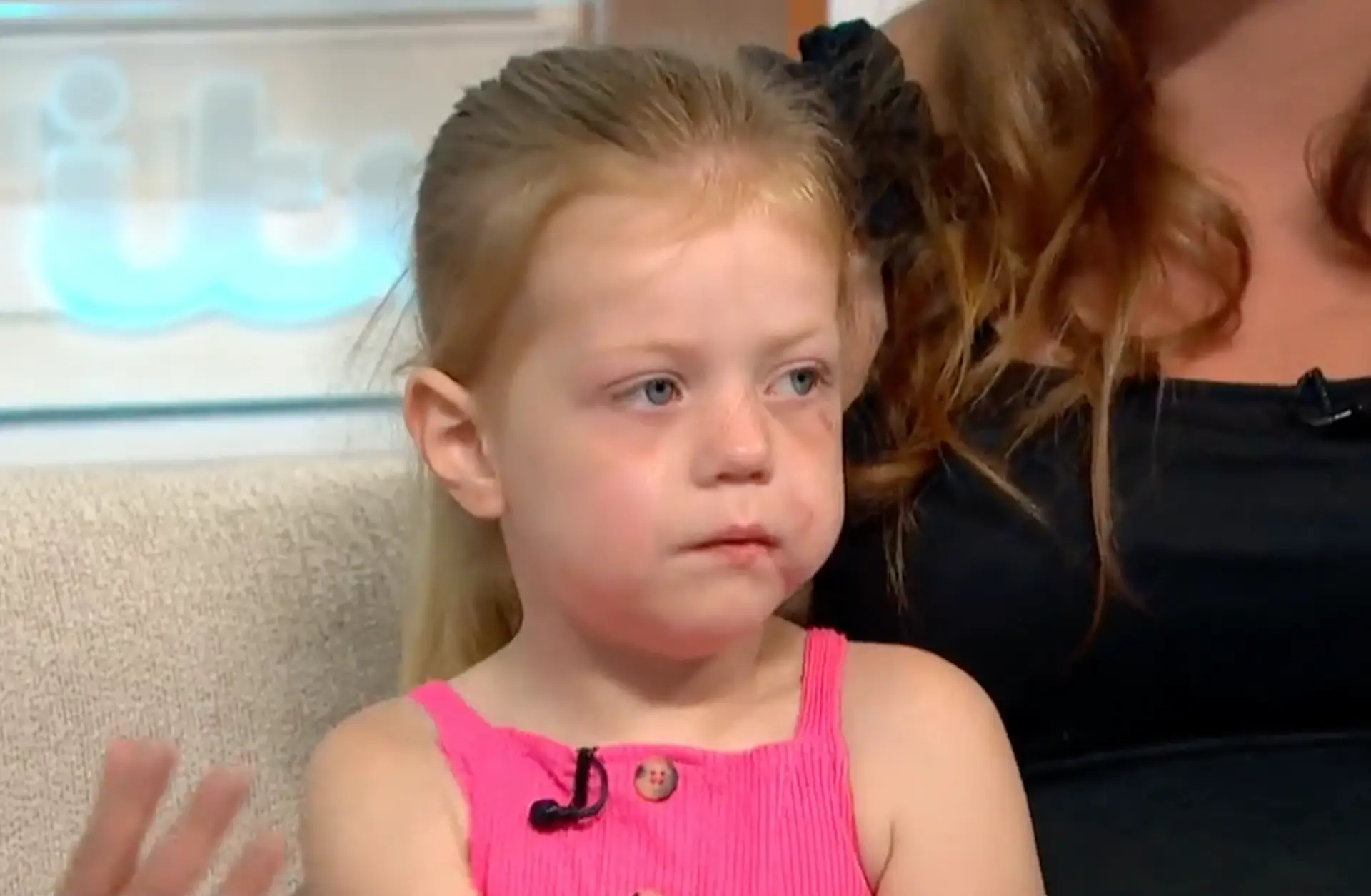 Luna-Ann's face has been left scarred.