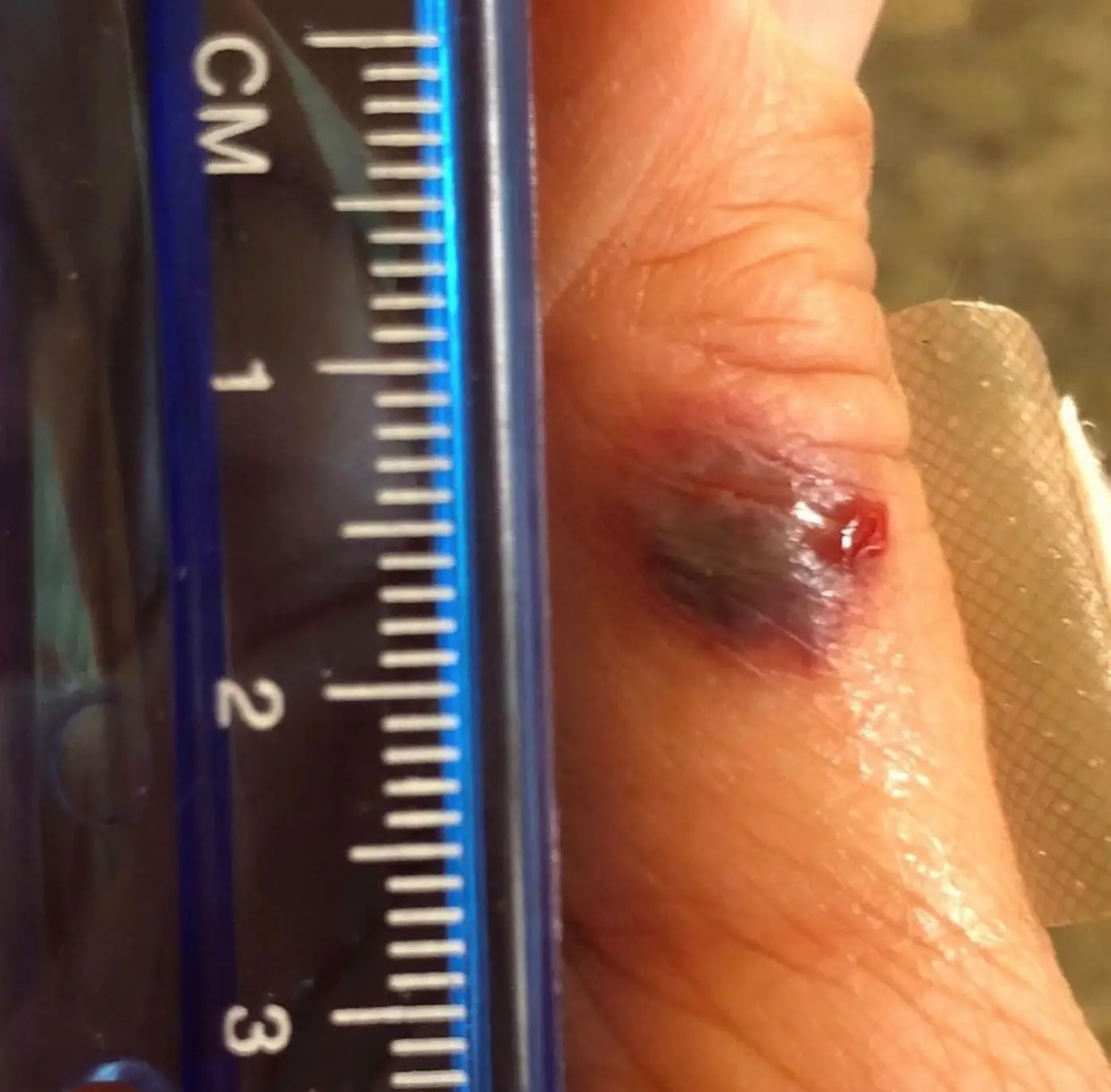 Katy noticed a purple mark on her thumb.