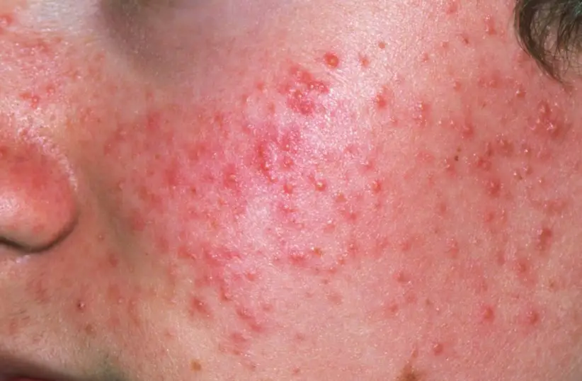 Acne often ‘presents differently' to a damaged skin barrier (NHS website)