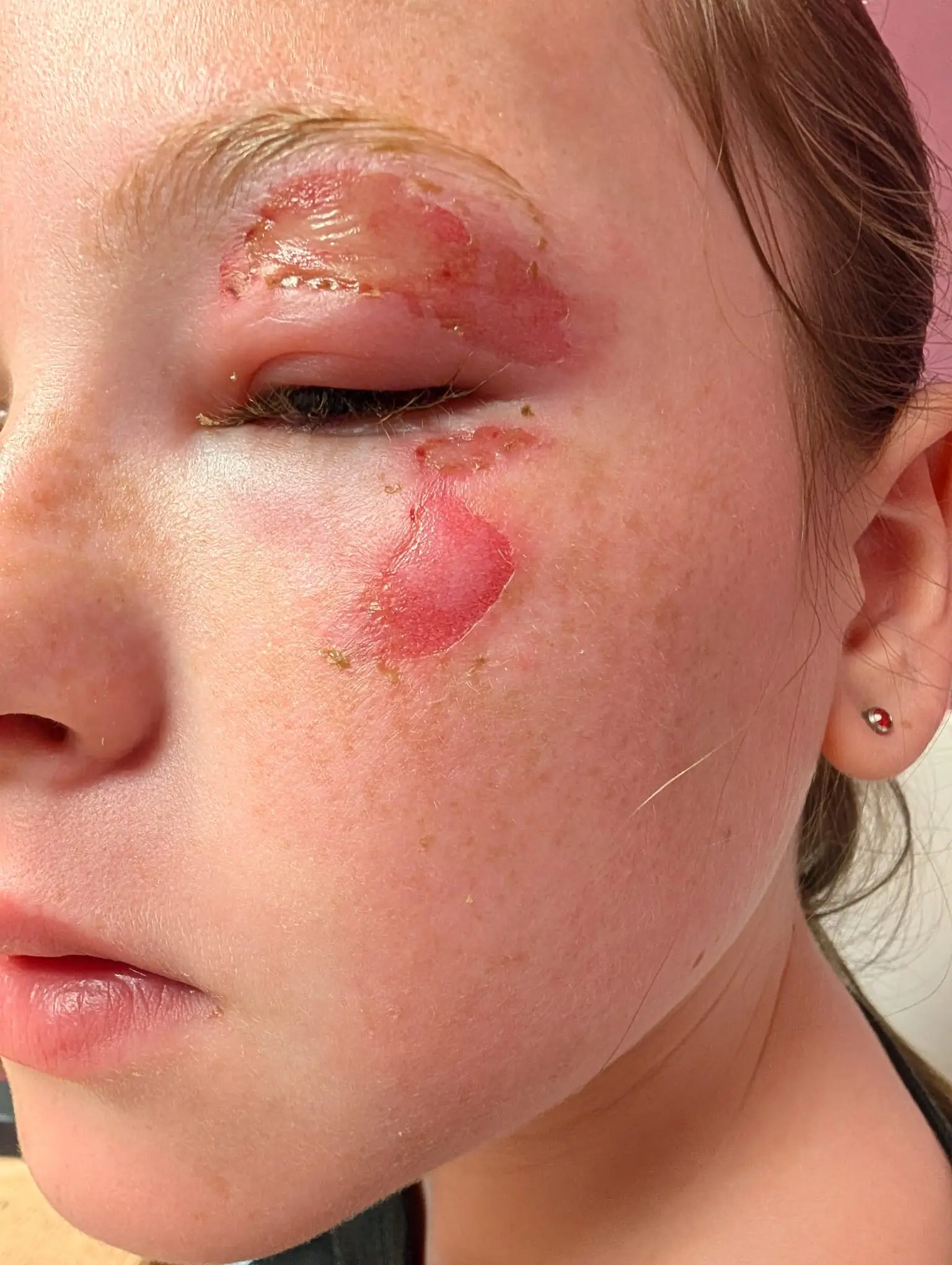 Scarlet suffered burns to her eyelid and face (Glasgow City Council)