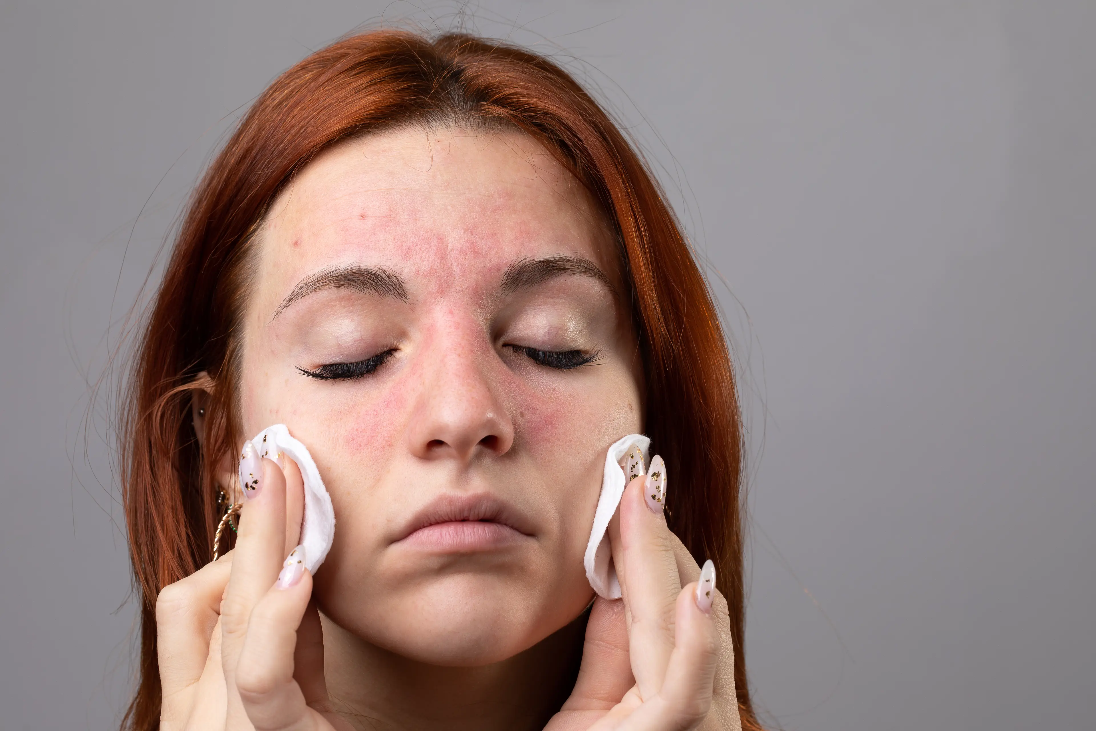 Redness on the face can also indicate a damaged skin barrier (Getty Stock Images)