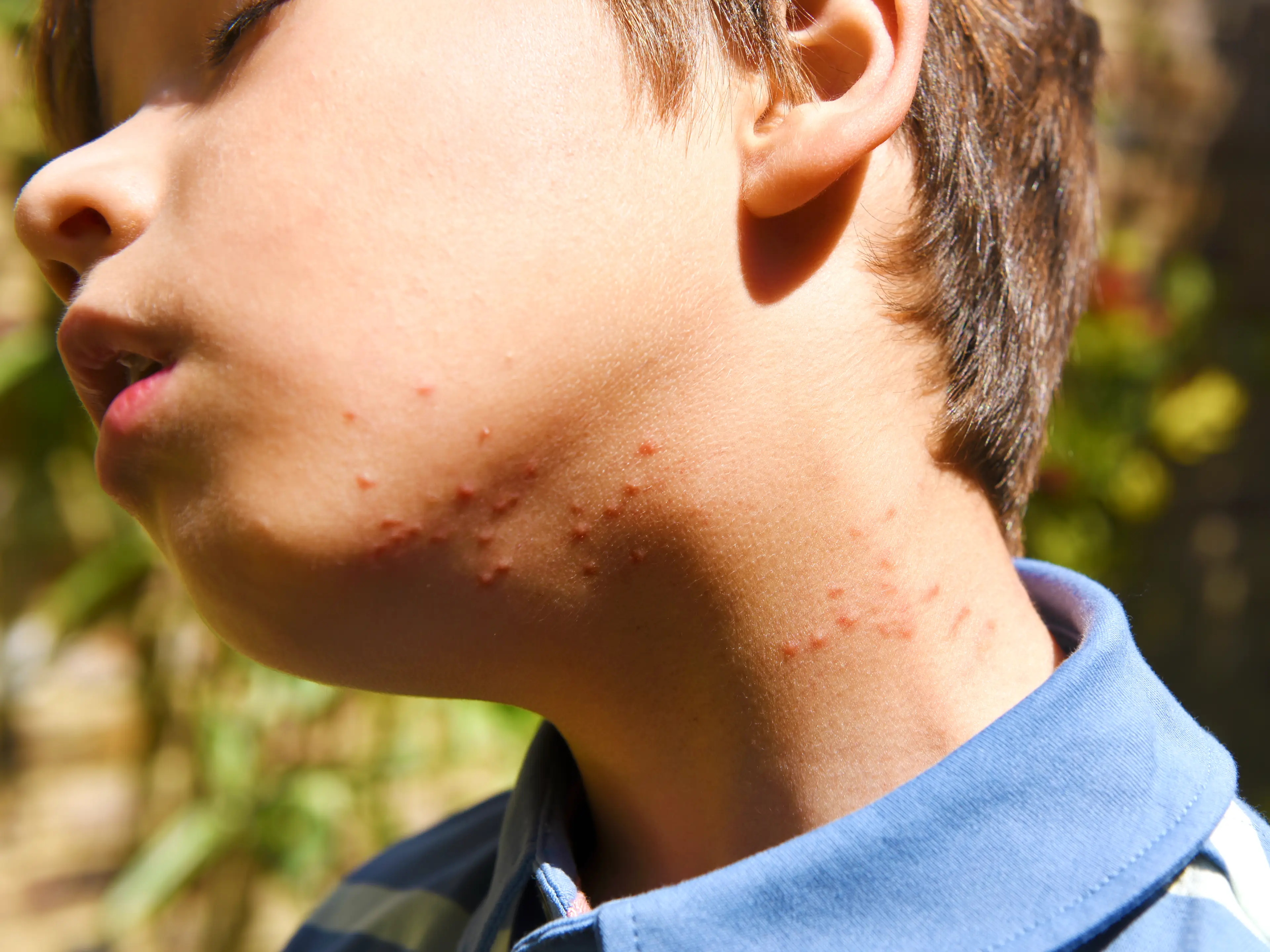 The NHS urges people to not scratch the bite or sting, as it could get infected (Getty Stock Images)