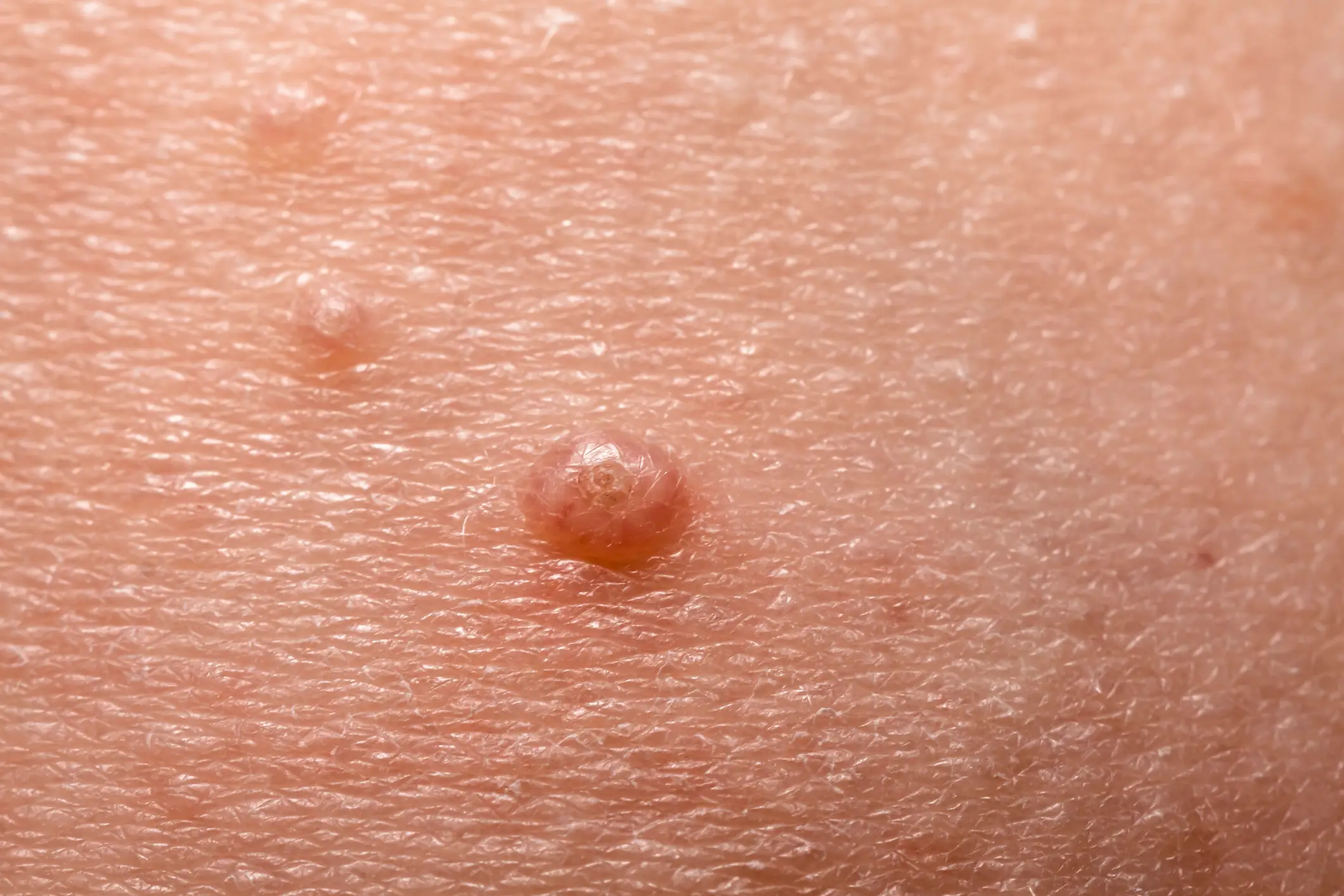 Molluscum contagiosum is a viral skin infection (Getty Stock Image)