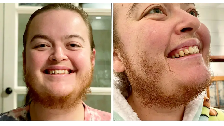 Woman Says She's 'Free' After Ditching Razor To Let Beard Grow