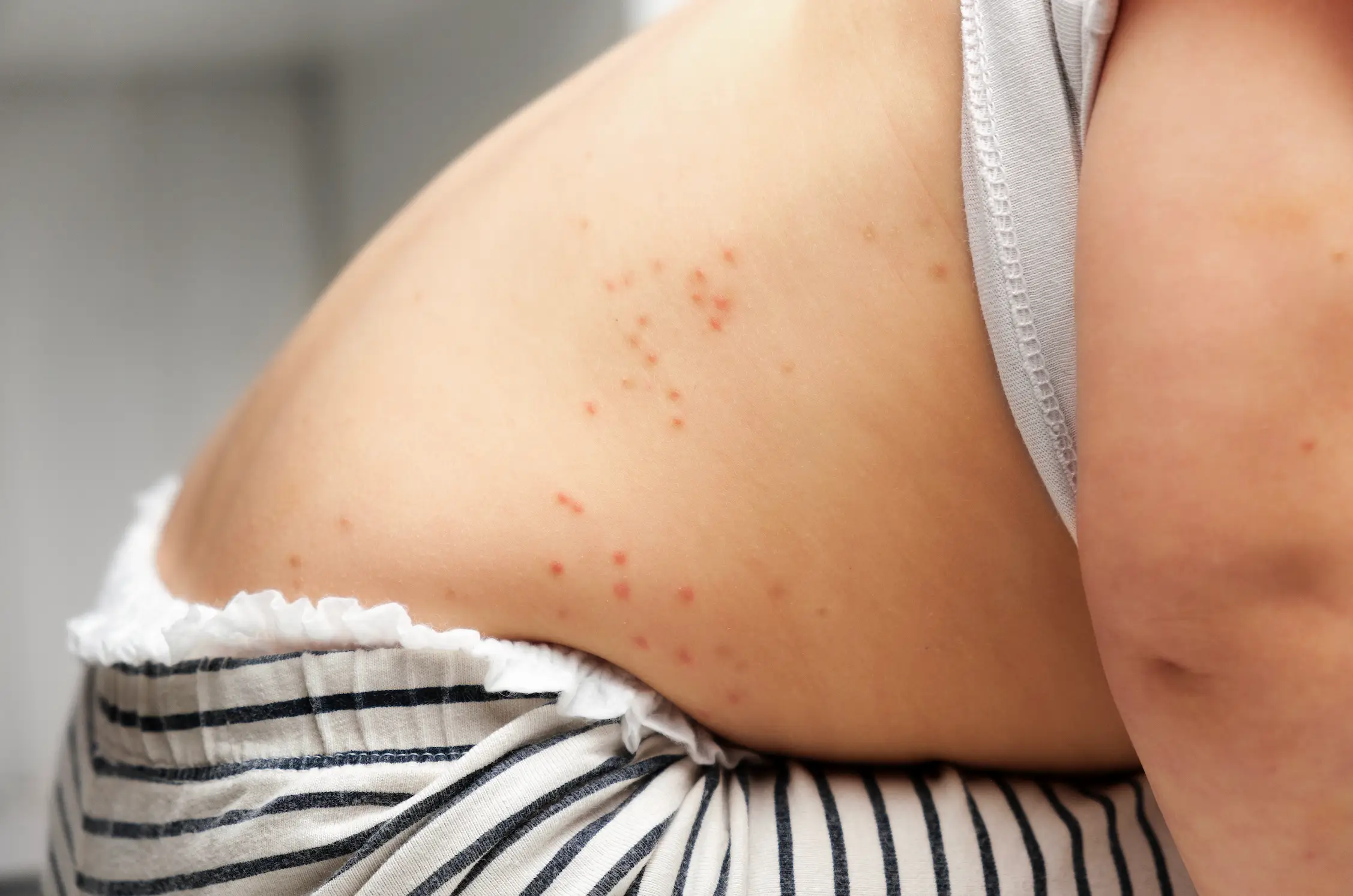 Parents should take their child to their GP if they notice any symptoms.