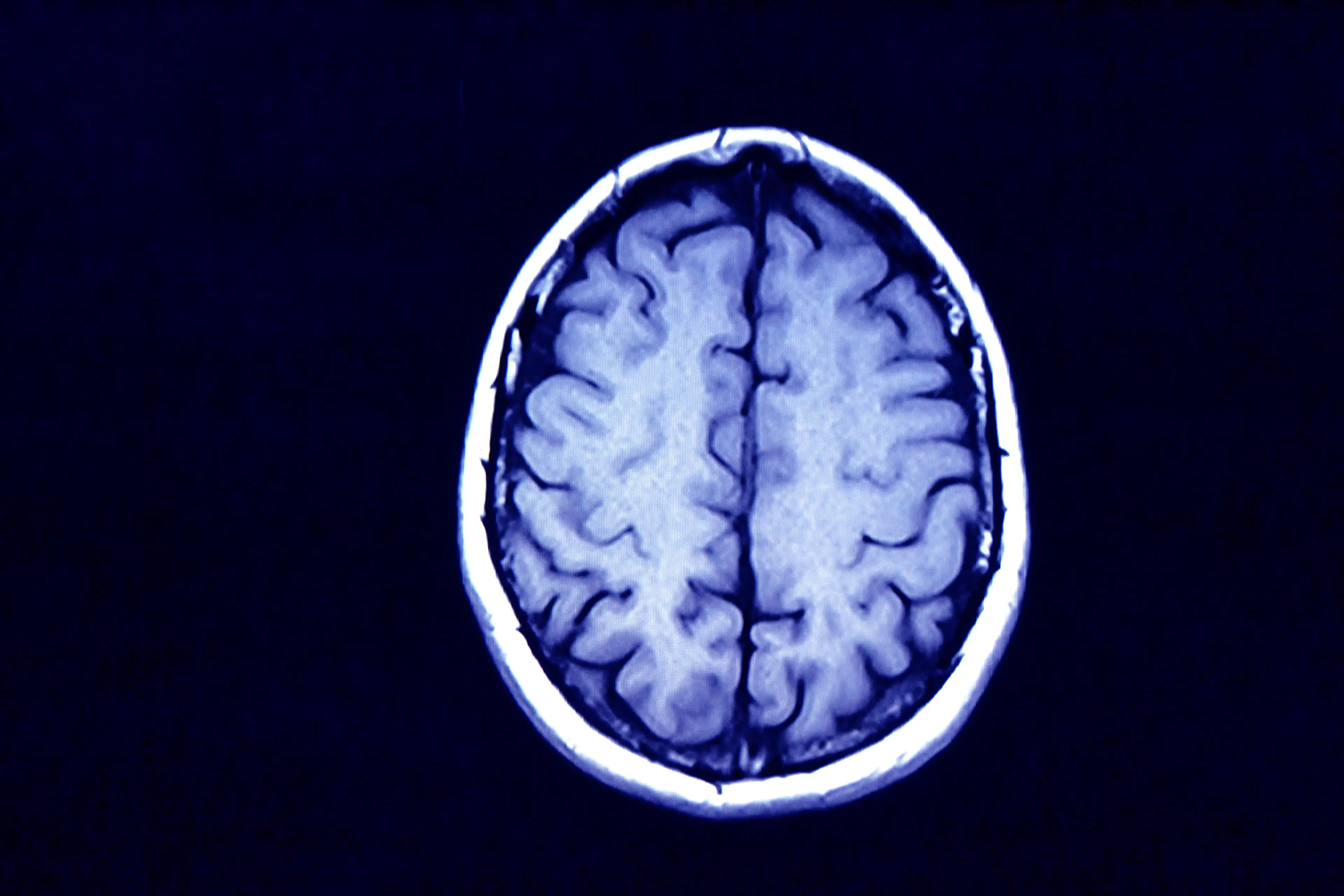 A neurologist has revealed the most 'concerning' thing she's found in patients' brains. (Getty stock image)