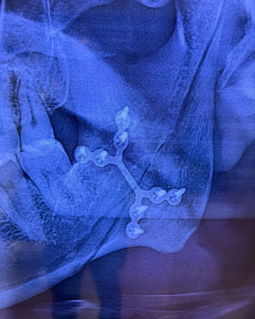 The blunt force trauma was so severe it snapped Hayes' 'left jawbone in half' (Instagram/@darrenhayes)