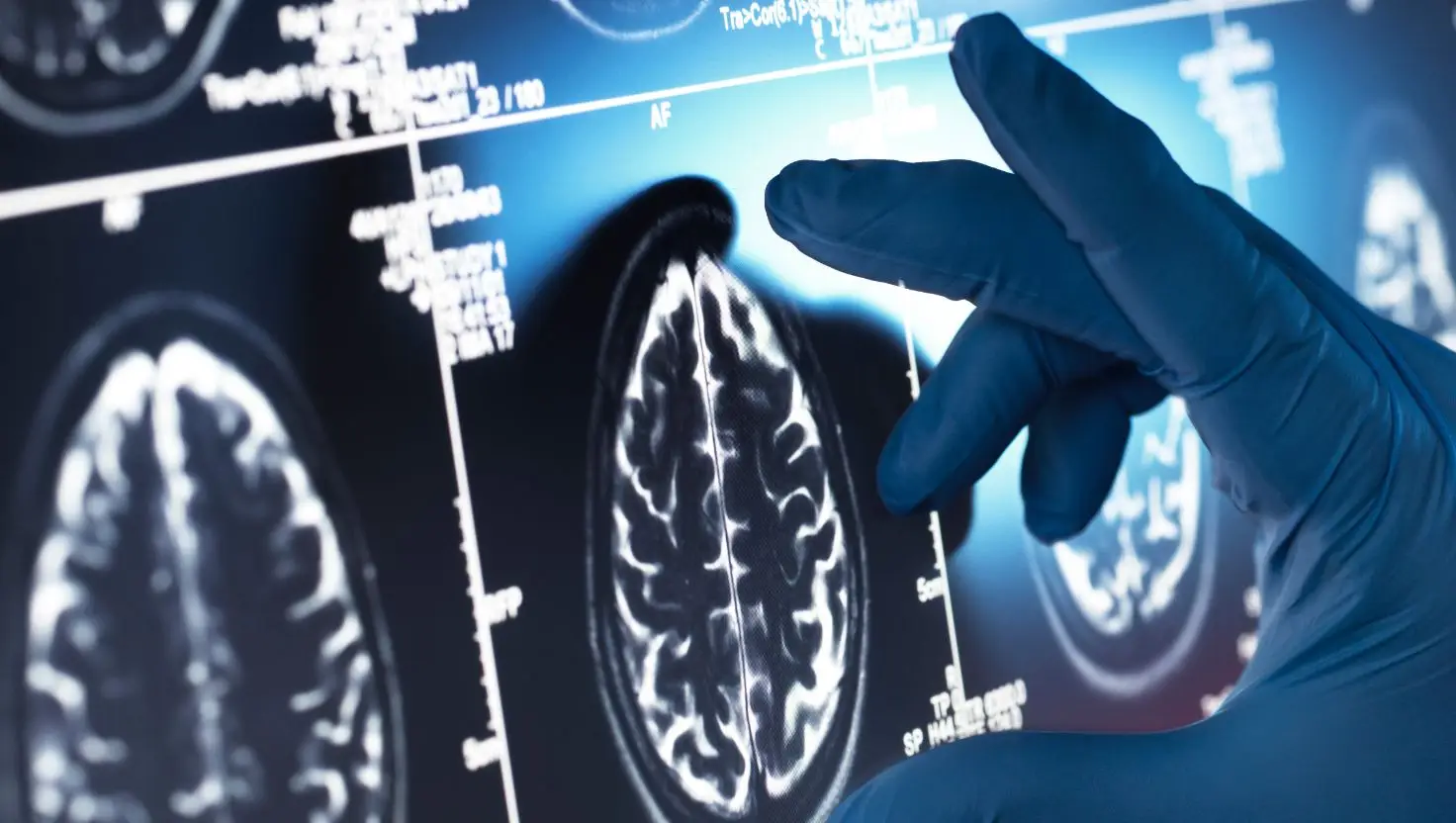 Scientists believe various factors can influence someone being diagnosed with dementia (Getty Stock Image)