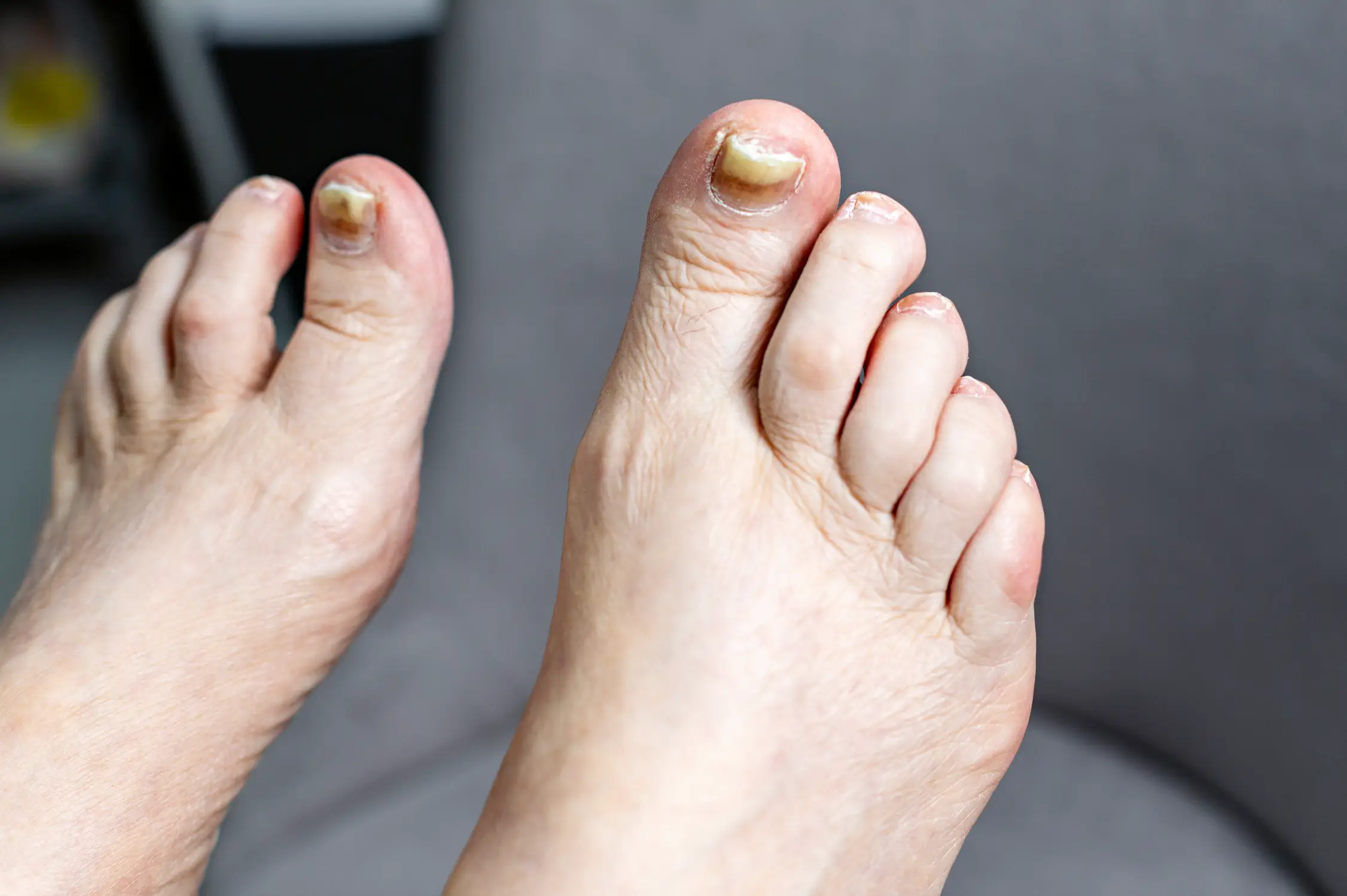 Thick toenails can be a sign of something more sinister happening behind the scenes (Ekaterina Rekina/Getty)
