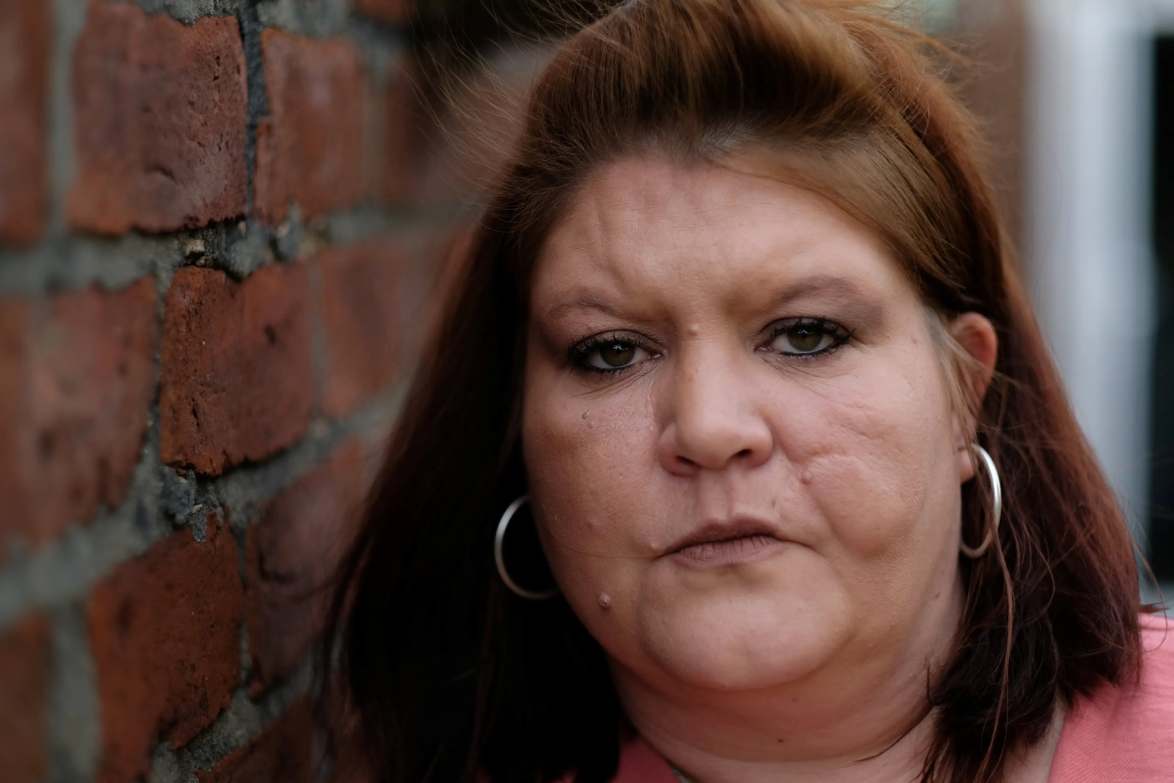 She needed nearly a dozen operations to repair her arm.