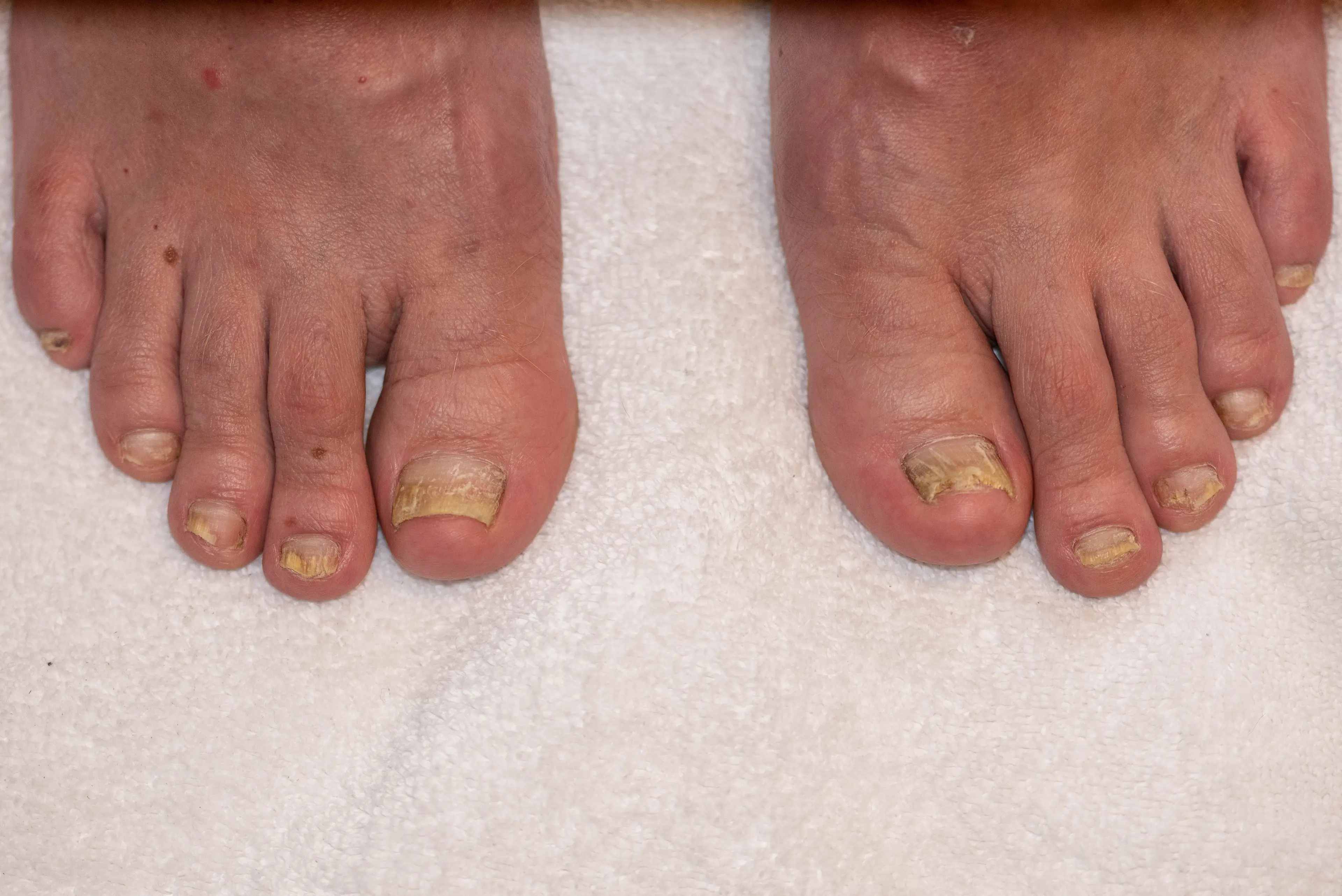 The condition could also cause a thickening or yellowing of the toenails (Getty Stock Image)