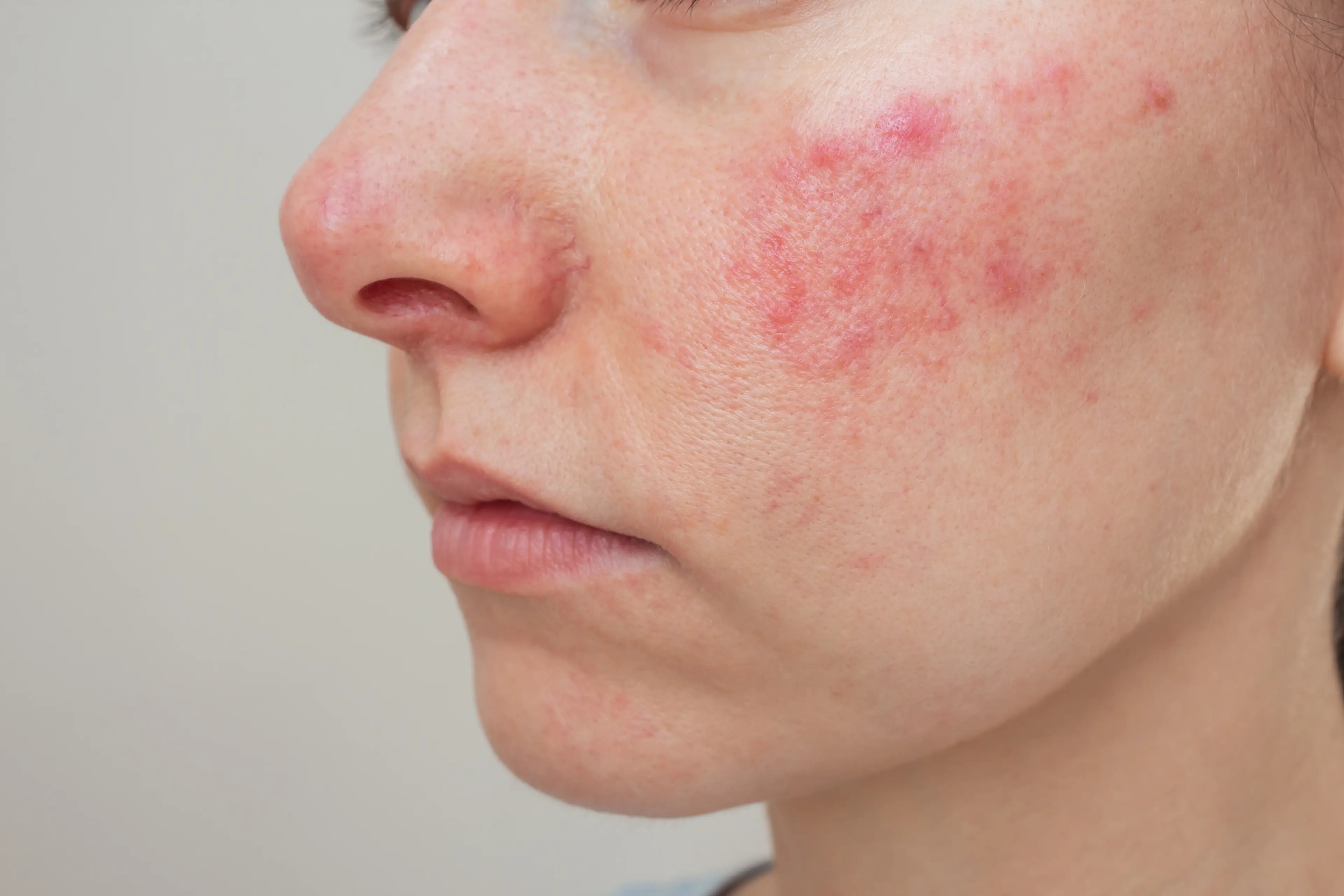 Rosacea has been linked in some cases to liver issues (Getty Stock)