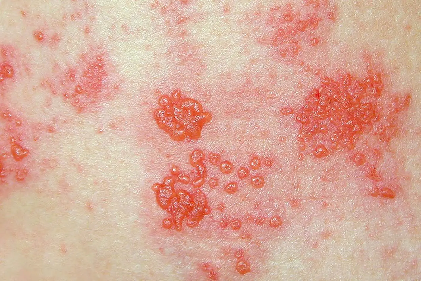 Reports of shingles have increased across all age groups between 1998 and 2019, but especially among those in their 30s and 40s (NHS)