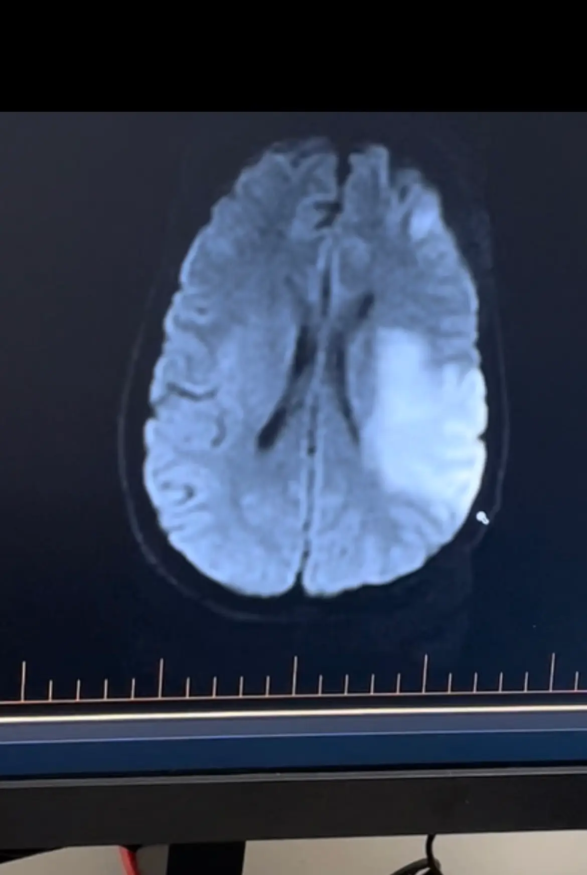 Amber Cavanagh suffered two strokes at the age of 40 in December 2021 (Supplied)