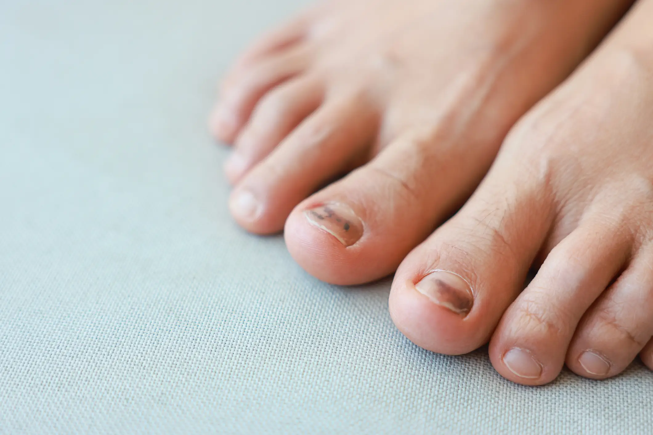 Discoloured toenails could be a sign of subungual melanoma (Getty Stock Images)