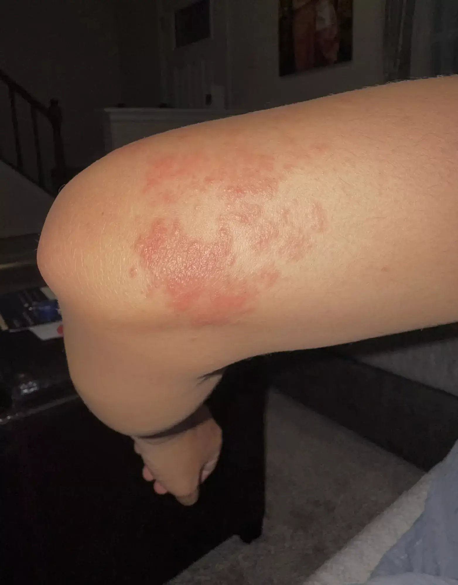 Ringworm is a highly contagious fungal disease (Kennedy News and Media)