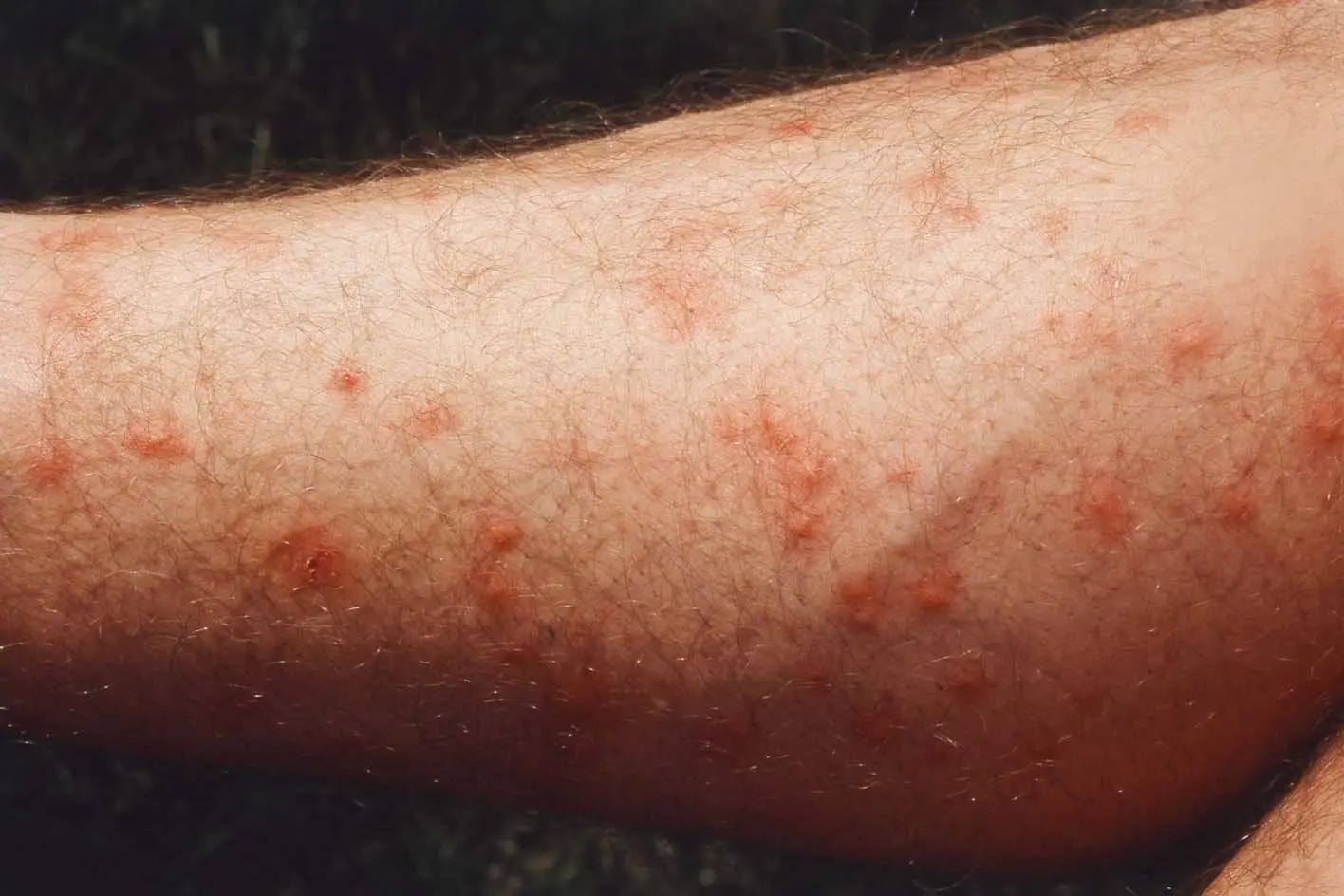 A pharmacist can recommend treatments, such as antihistamines and steroid creams, and give the same antibiotics as a GP if the bite or sting is infected (NHS)