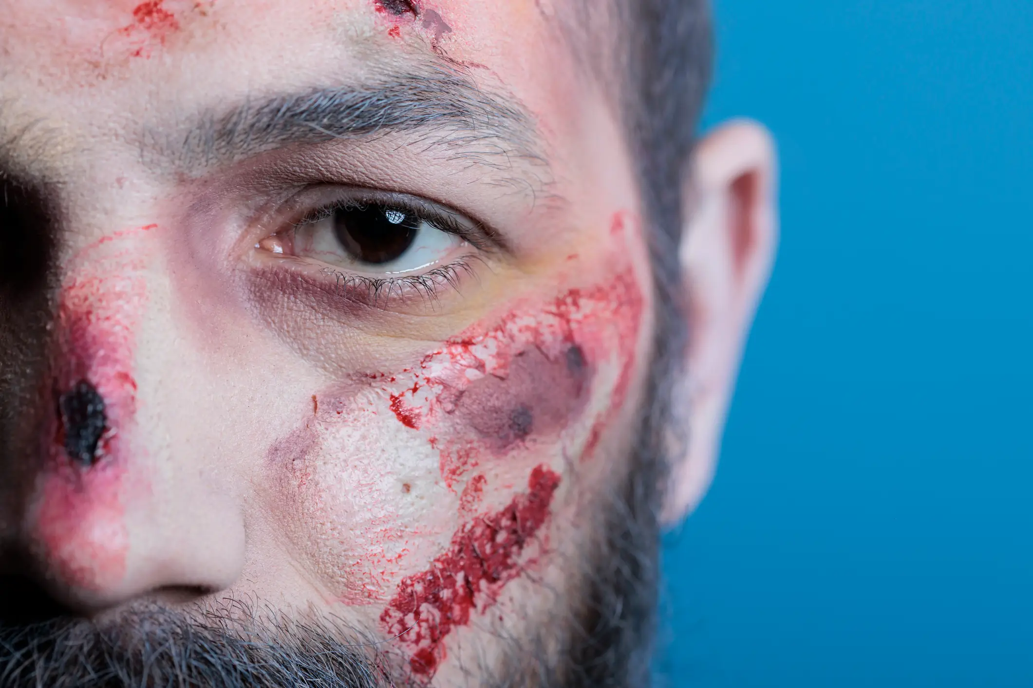 The trend can cause fractures and bruising (Getty Stock Photo)