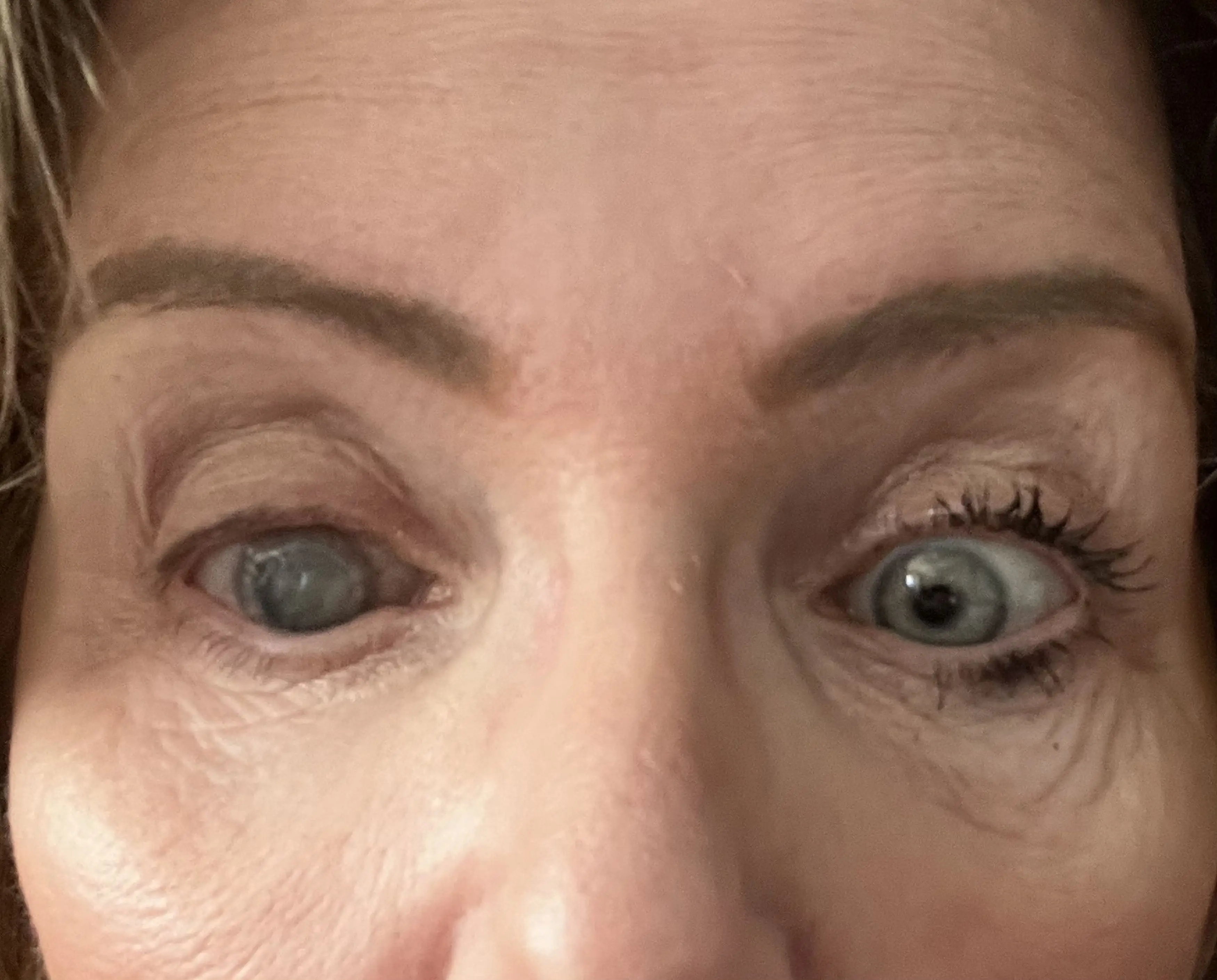 Maureen said she is now almost completely blind in her right eye and is waiting to undergo a second cornea transplant (Kennedy News and Media)