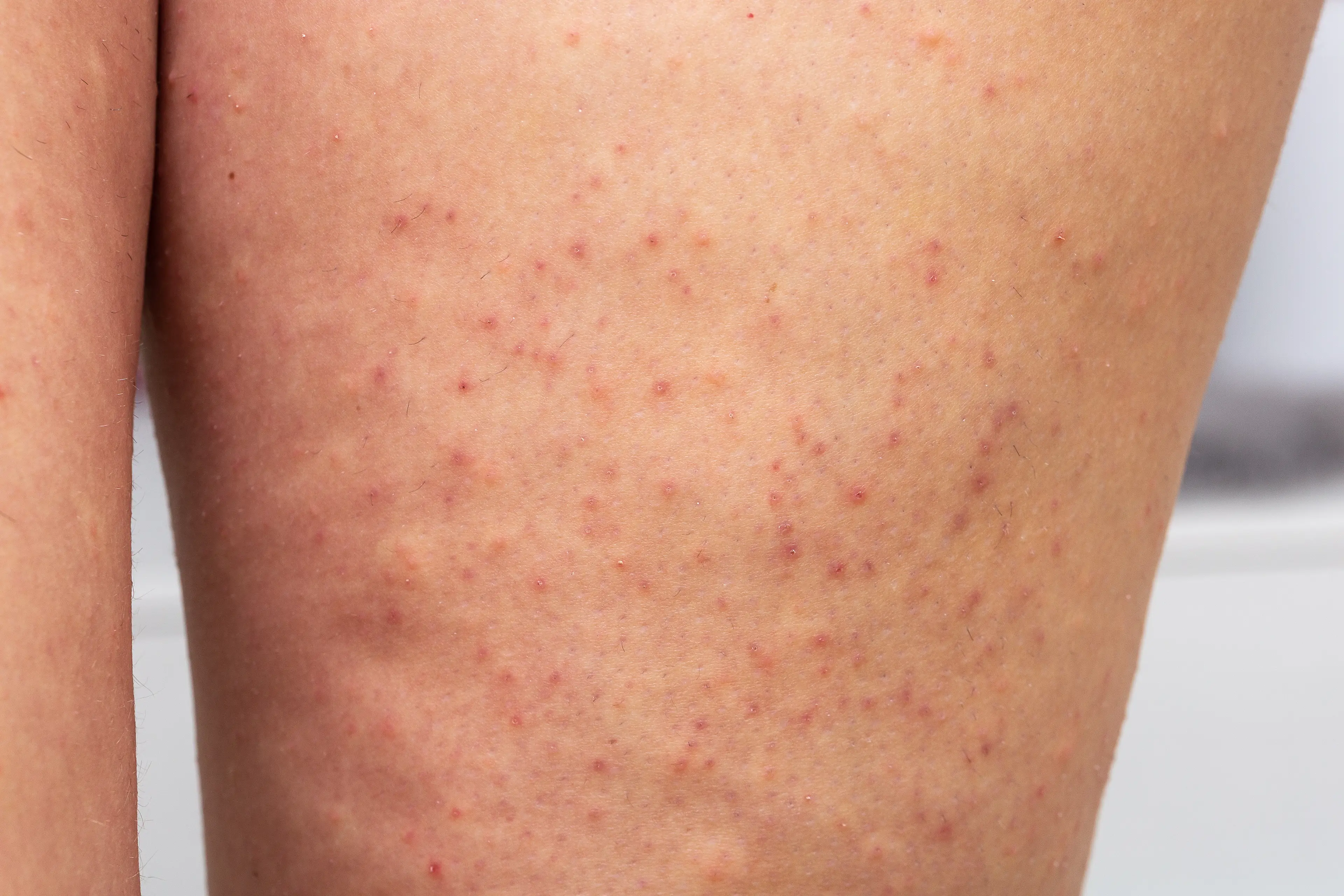 Keratosis pilaris is commonly referred to as 'chicken skin' (Getty Stock Image)