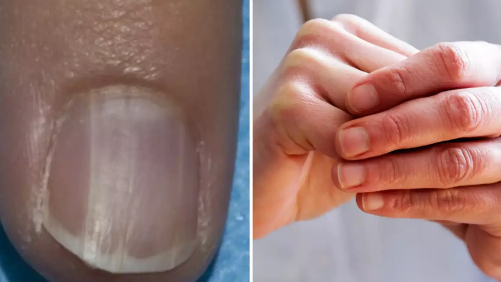 Dermatology Consultation Service/NIAMS/Kinga Krzeminska/Getty Images