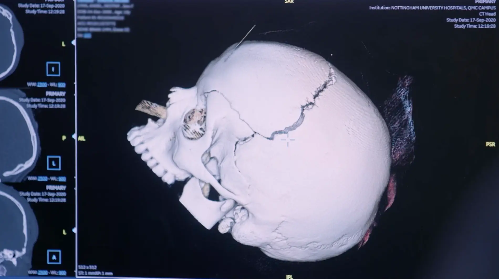 Angel's injury was 'so devastating' that doctors thought she might not survive.