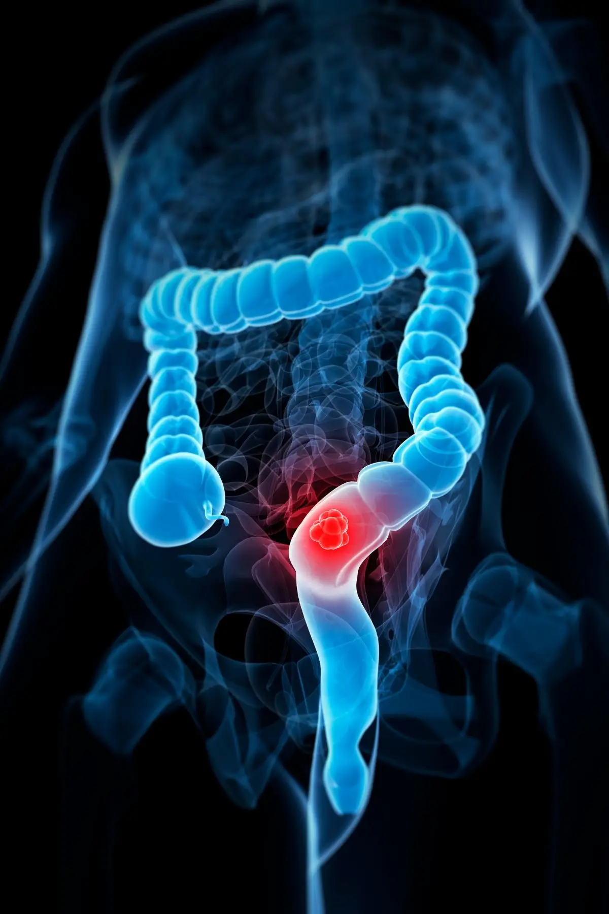 Bowel cancer cases are sadly on the rise (Getty Stock Image)