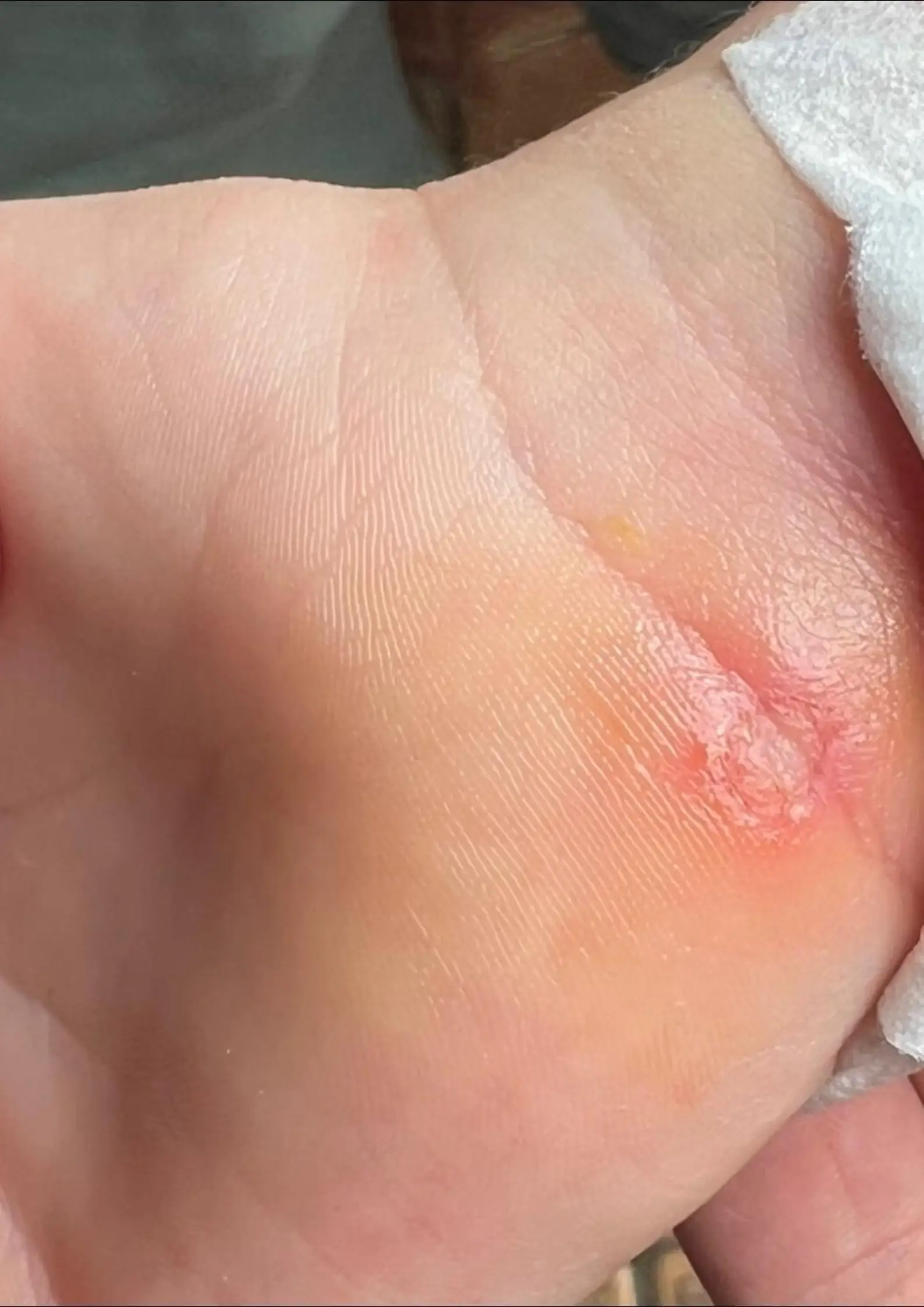 One mum warned other parents to keep an eye out after her daughter caught a lymph infection.