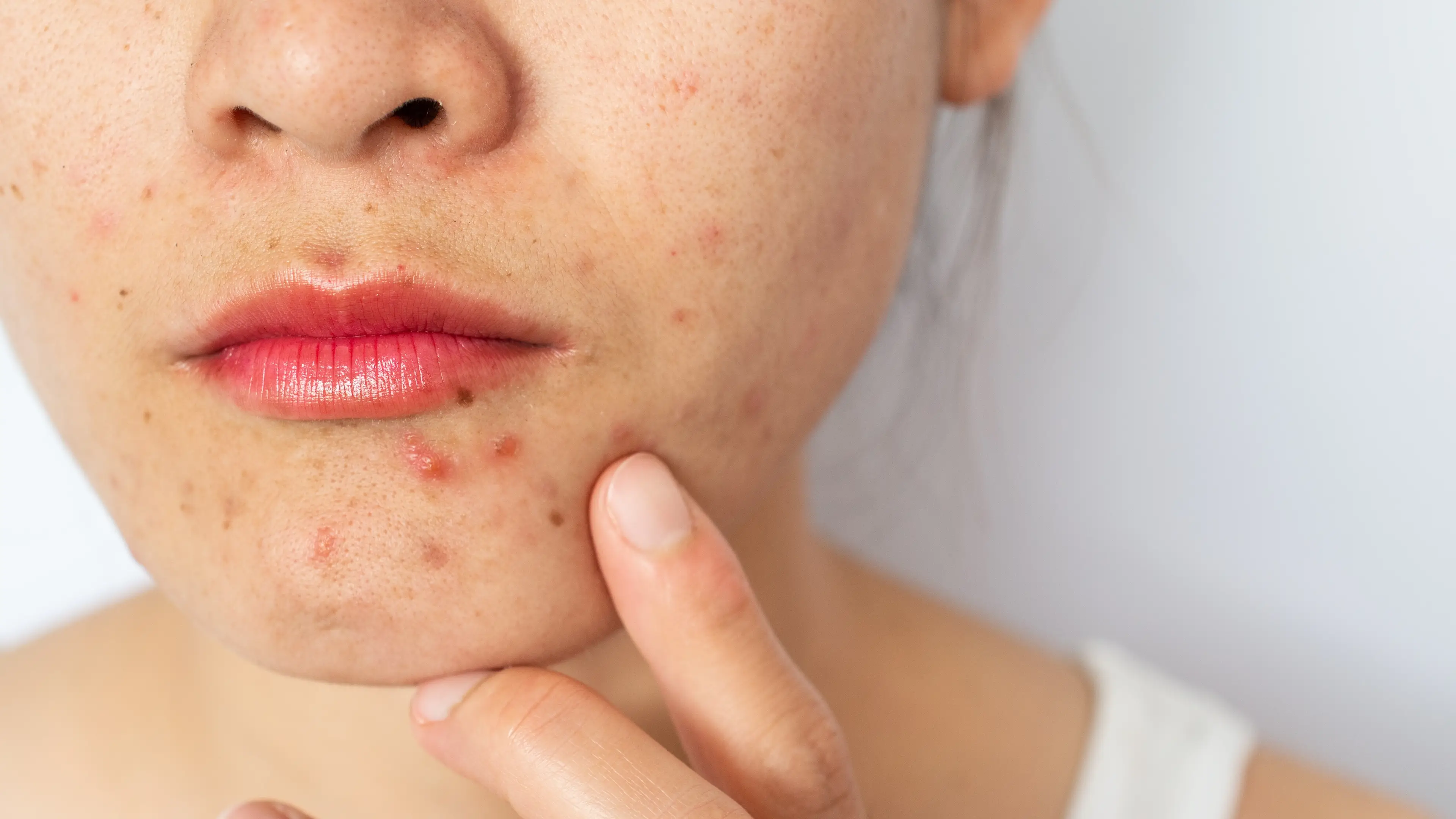 Medical dermatologist reveals what really causes face acne and the answer may surprise you