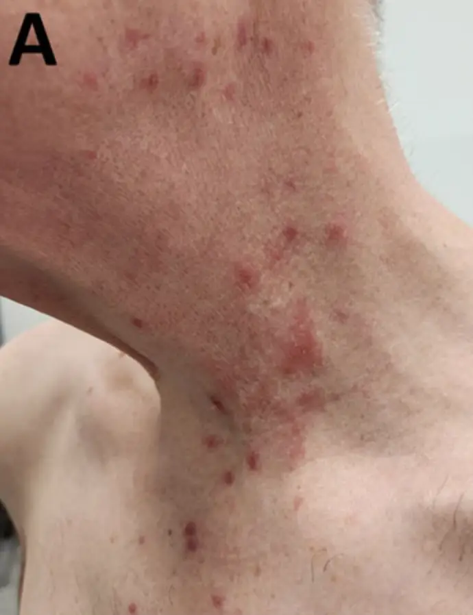 The condition has been reported in LGBTQ+ men (CDC)