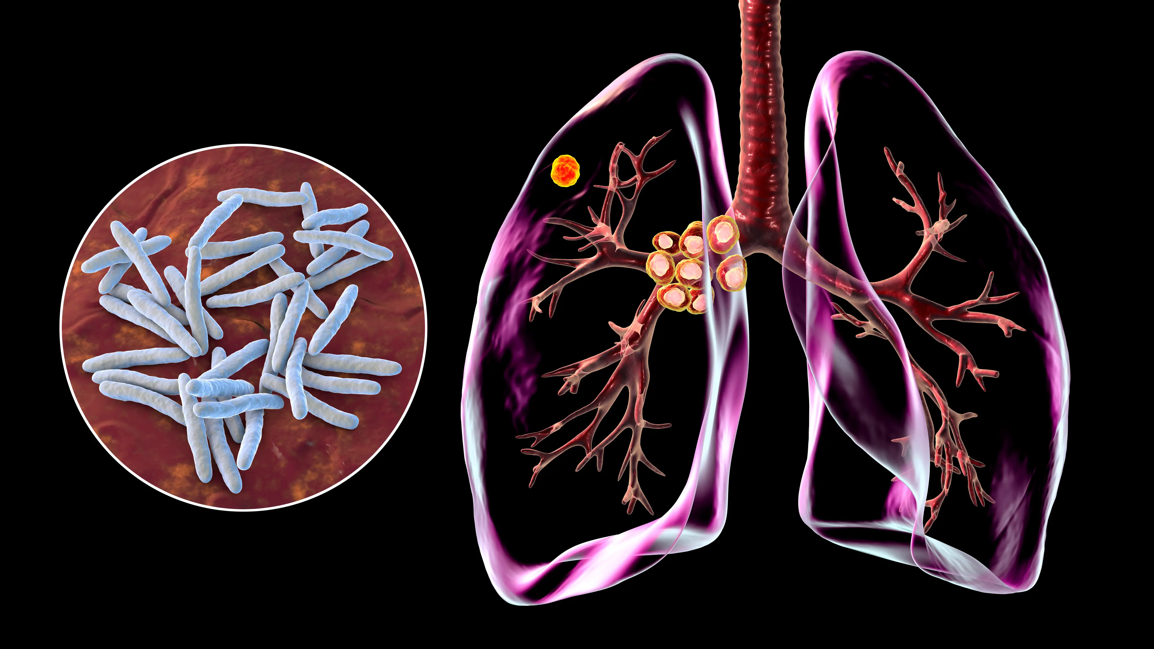 The condition primarily affects the lungs (Getty Stock Images)