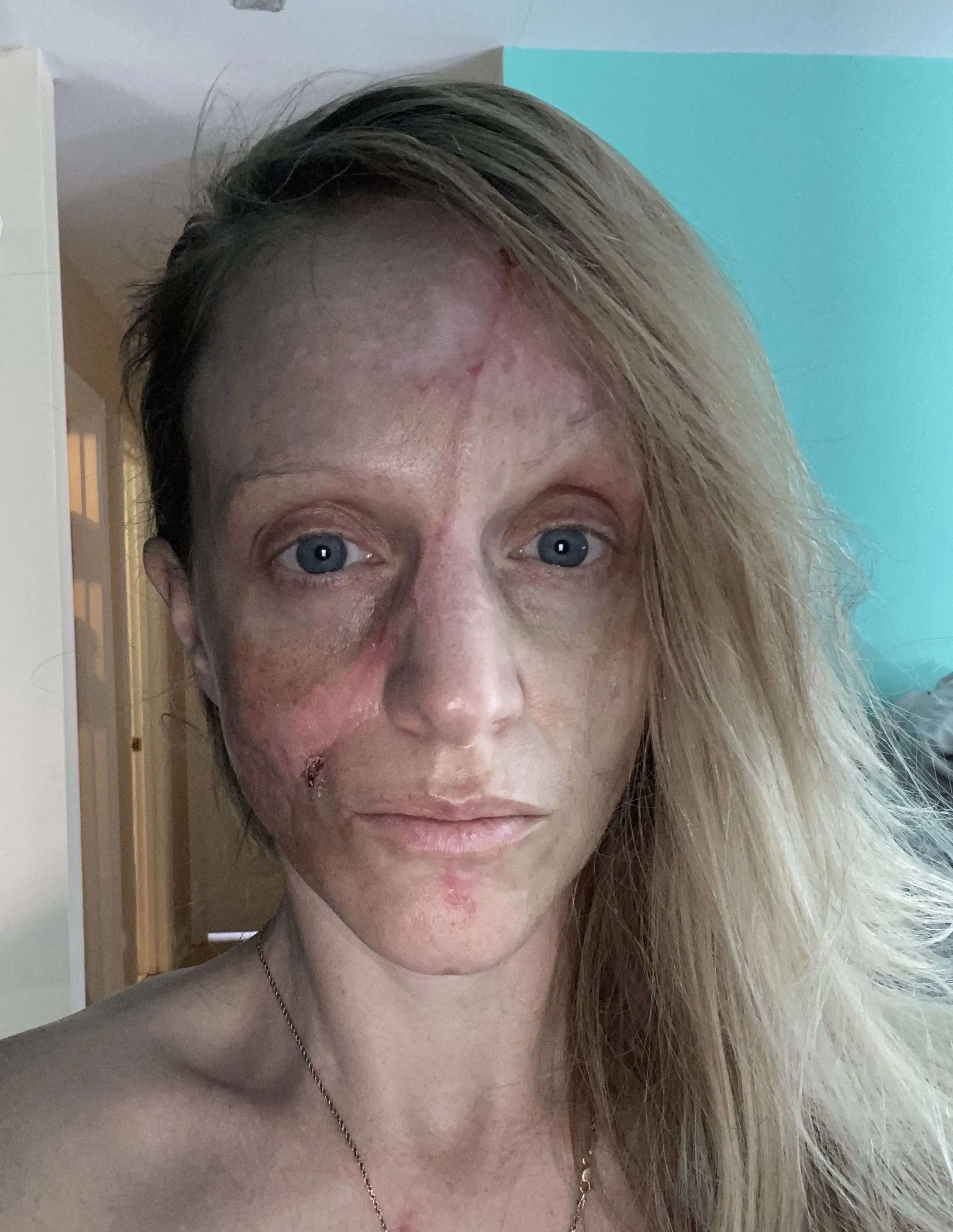 Shelley is now fundraising to undergo further surgery.