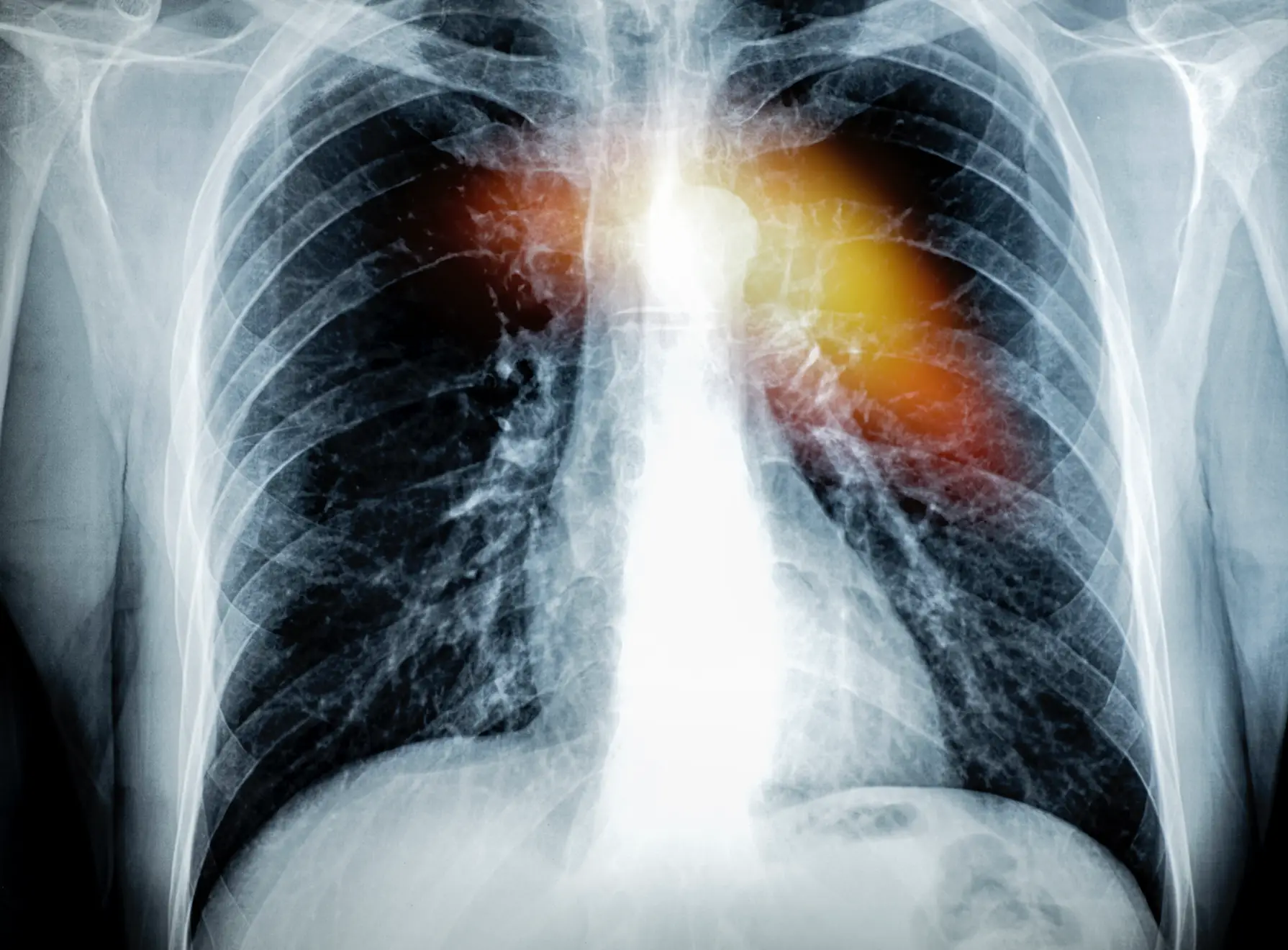 Women are more likely to suffer a 'silent heart attack' than men. (	Jose A. Bernat Bacete/Getty)