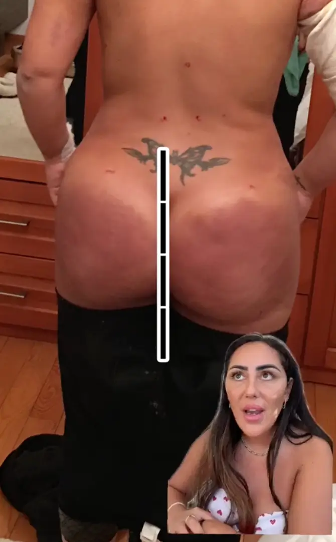 Sophie began suffering pain in her new bum.