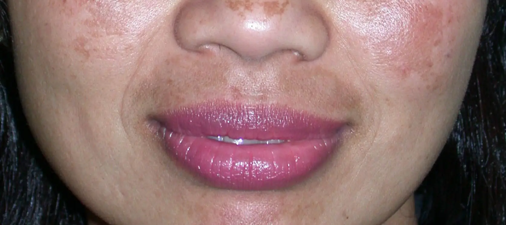 An example of melasma (British Skin Foundation)