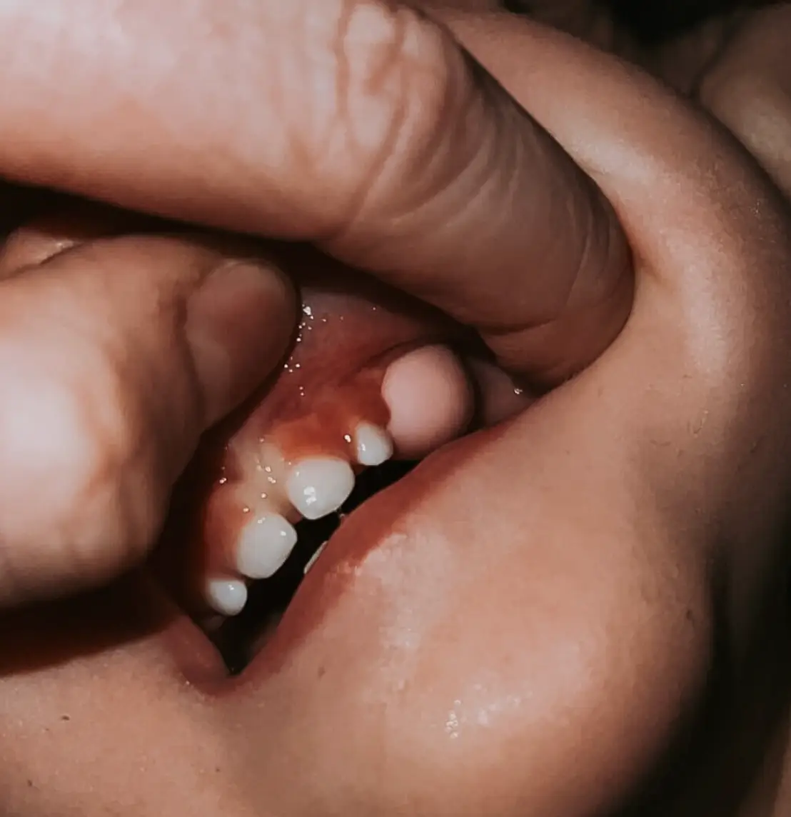 The piece was wedged behind the child's back teeth.