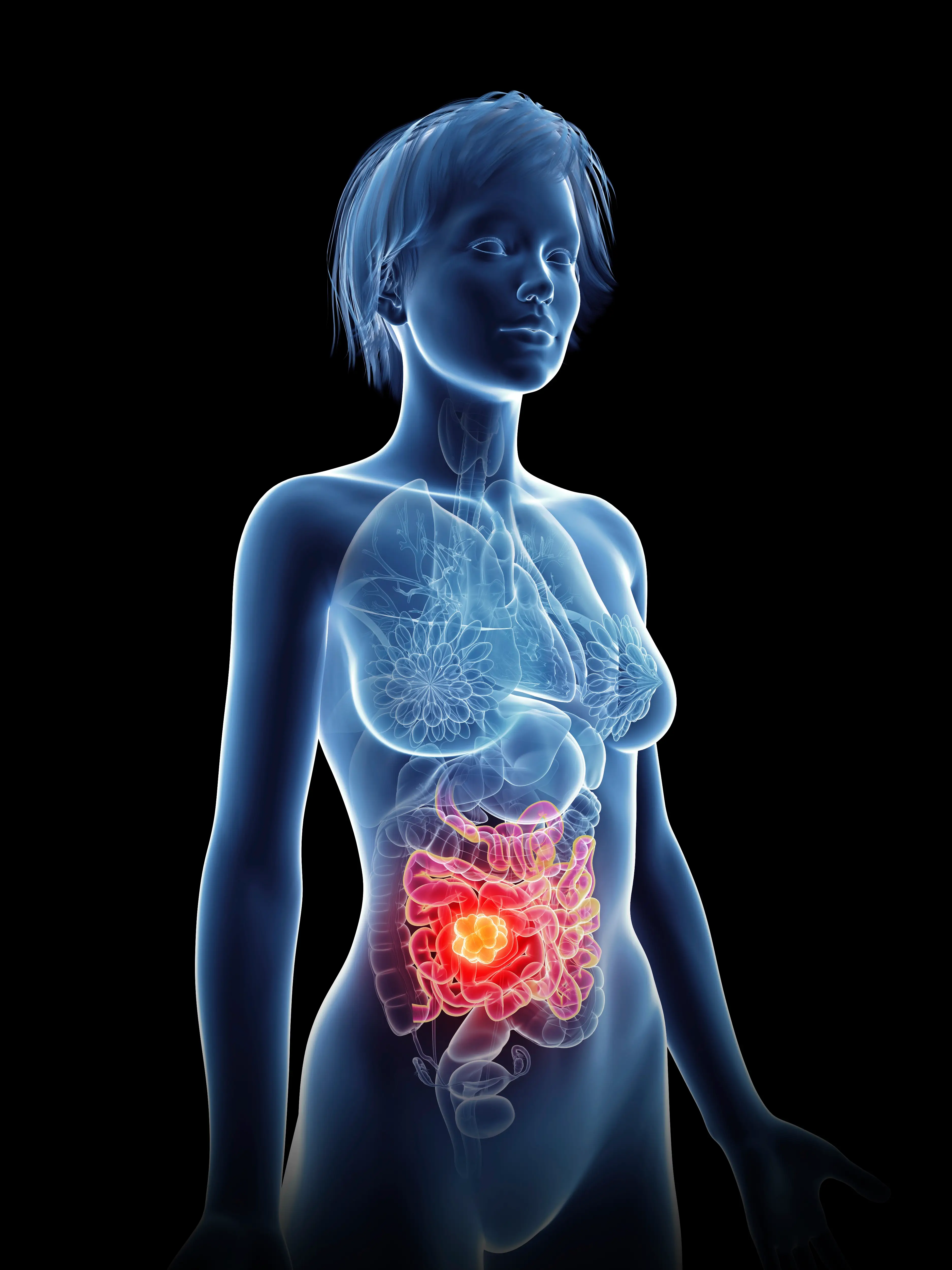 Colon cancer is the third most common cancer worldwide (Getty Stock Image)