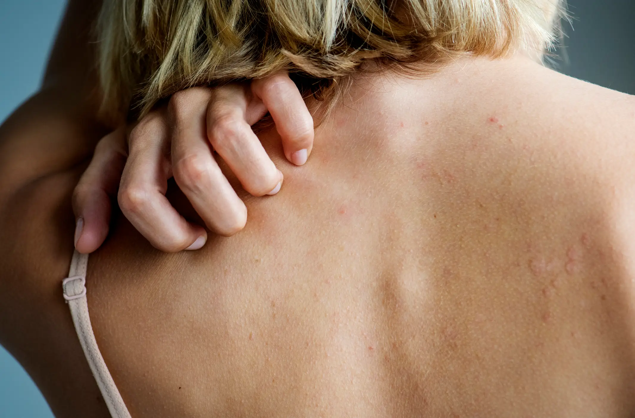 Itching is a common symptom of some types of cancer (Rawpixel / Getty Images)