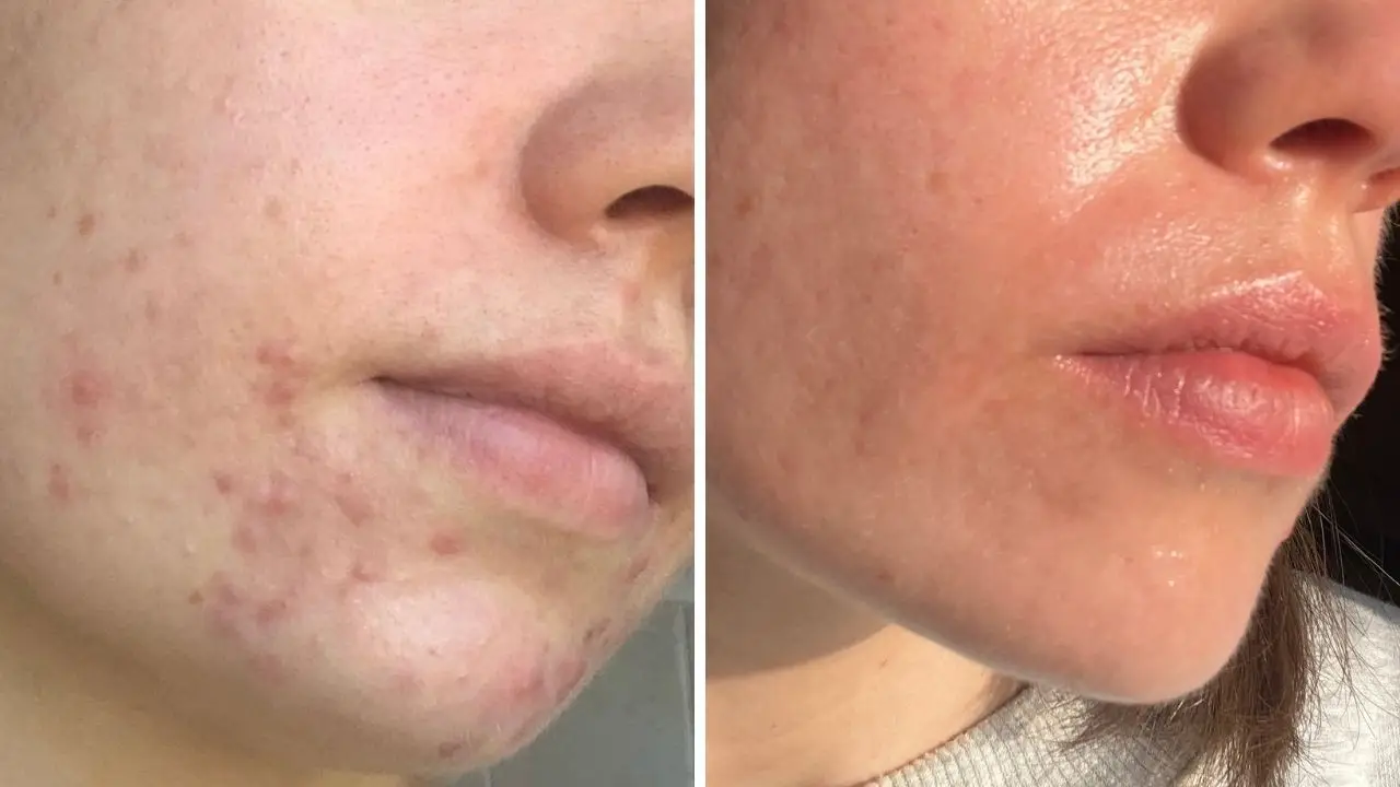 Before and after a year-long course of Isotretinoin to combat my adult acne