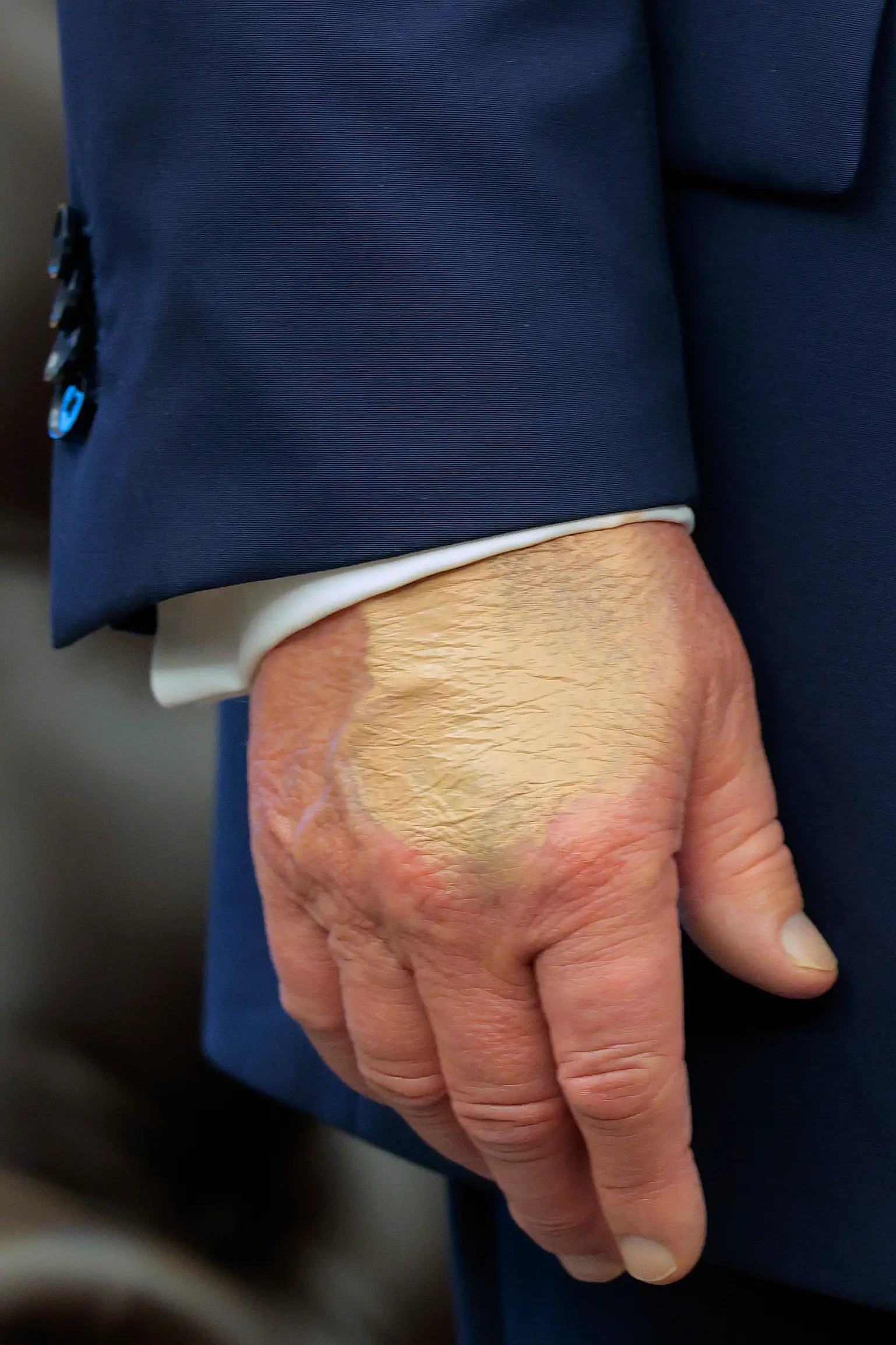 A social media user believes Trump's bruising could be down to using IV drips (Chip Somodevilla/Getty Images)