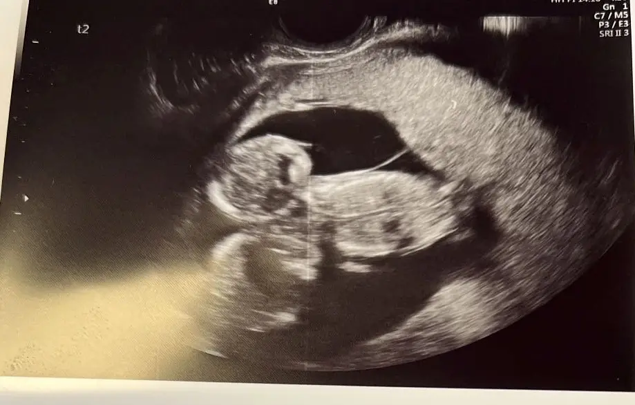 The parents were convinced their triplets were boys.