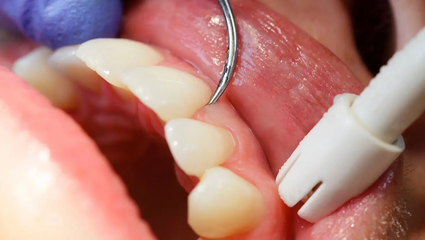 Let this be a 'sobering warning' to not skip your next dental appointment (Getty Stock Image)